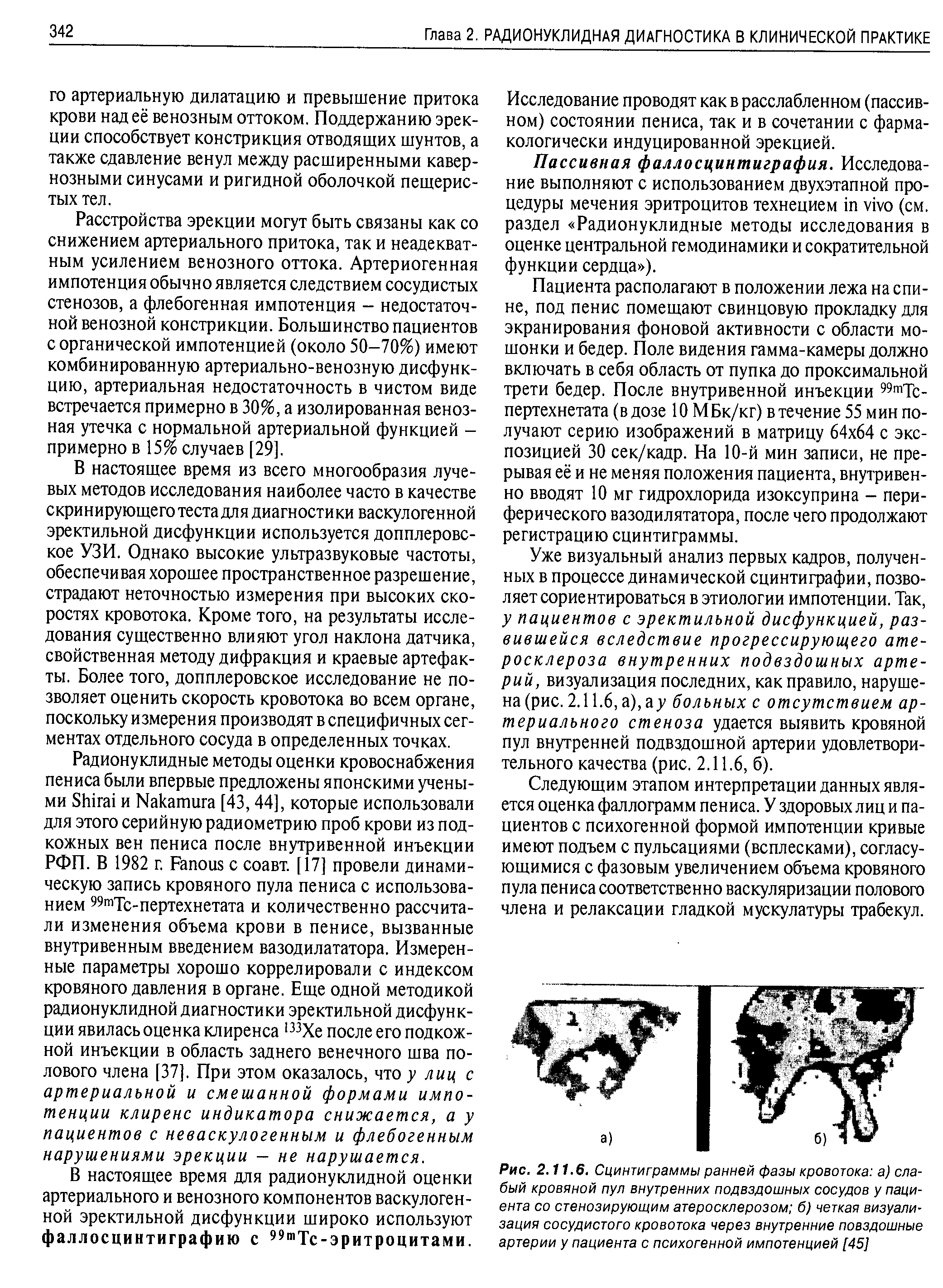 Рис. 2.11.6. Сцинтиграммы ранней фазы кровотока а) слабый кровяной пул внутренних подвздошных сосудов у пациента со стенозирующим атеросклерозом б) четкая визуализация сосудистого кровотока через внутренние повздошные артерии у пациента с психогенной импотенцией [45]...
