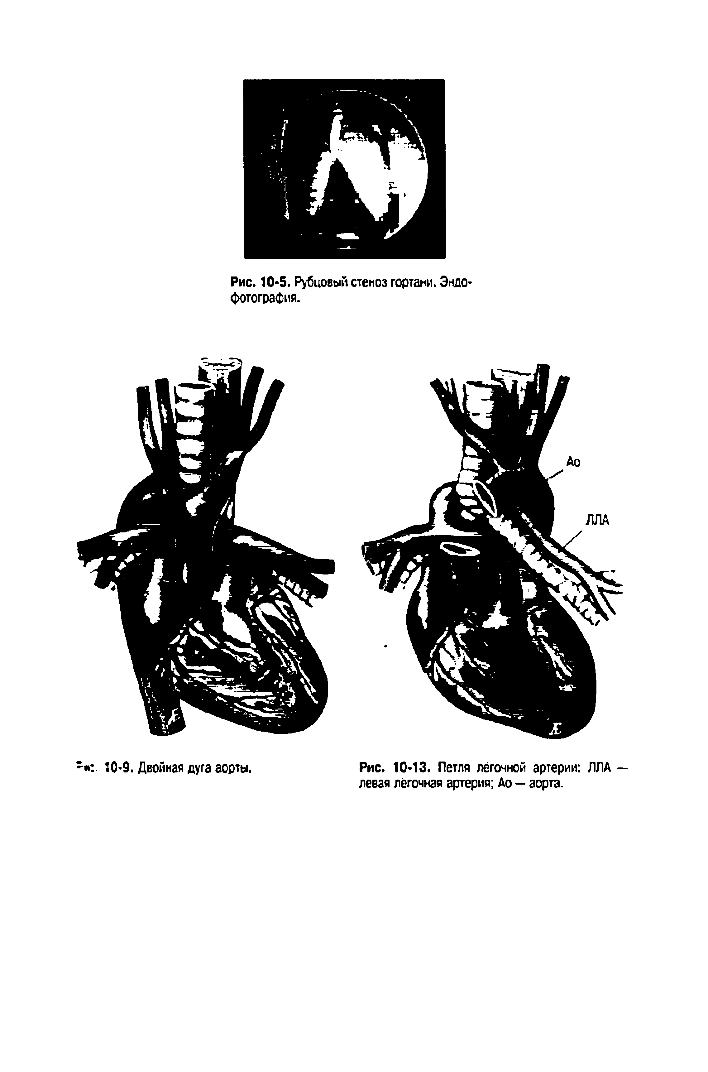 Рис. 10-13. Петля лёгочной артерии ЛЛА — левая лёгочная артерия Ао - аорта.