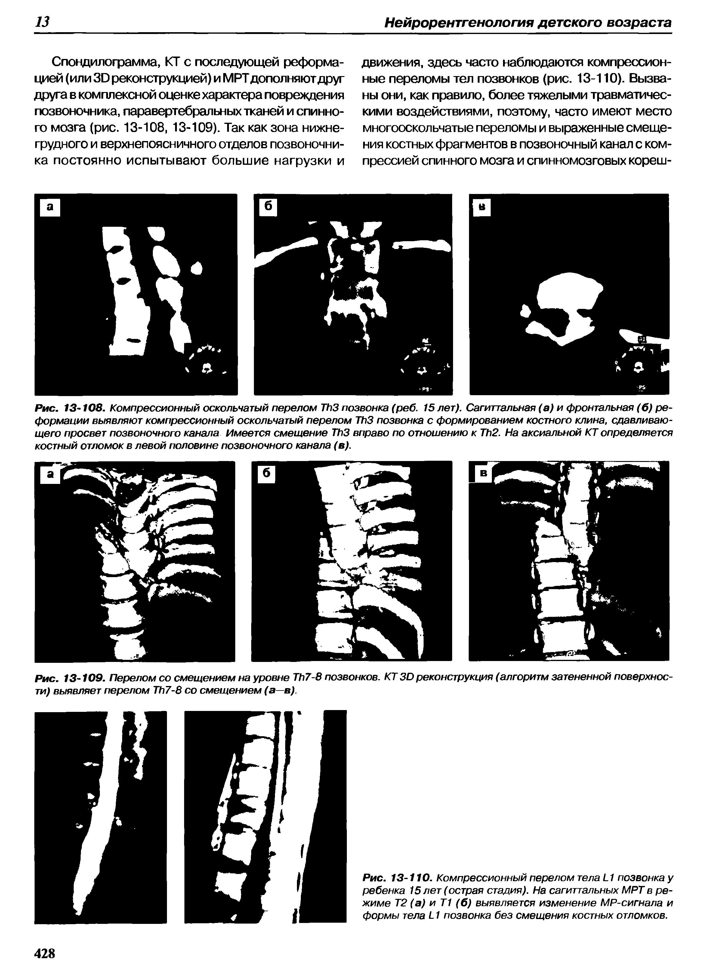 Рис. 13-108. Компрессионный оскольчатый перелом T 3 позвонка (реб. 15 лет). Сагиттальная (а) и фронтальная (б) реформации выявляют компрессионный оскольчатый перелом T 3 позвонка с формированием костного клина, сдавливающего просвет позвоночного канала Имеется смещение T 3 вправо по отношению к T 2. На аксиальной КТ определяется костный отломок в левой половине позвоночного канала (в).