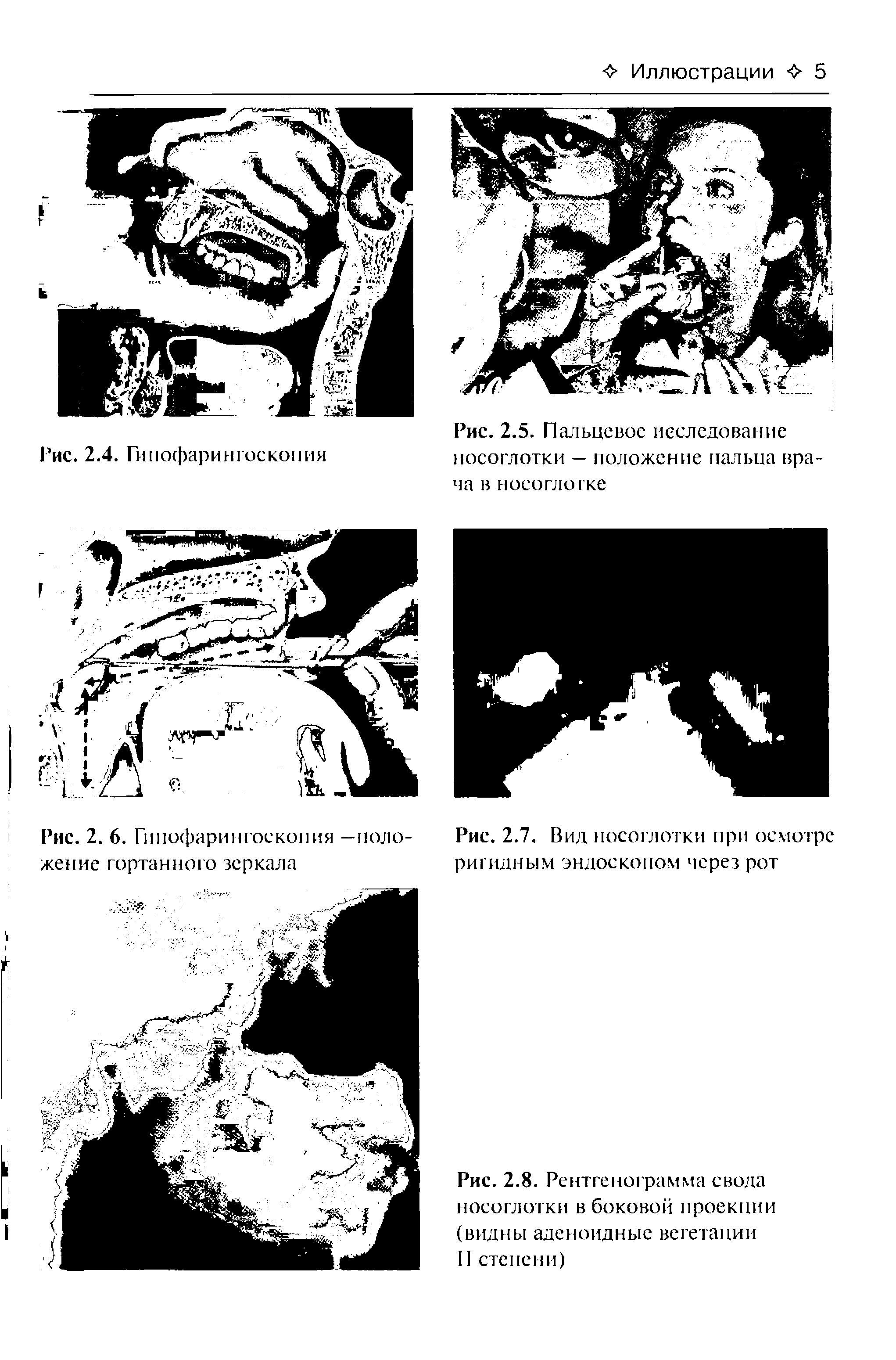 Рис. 2.5. Пальцевое исследование носоглотки — положение пальца врача в носоглотке...