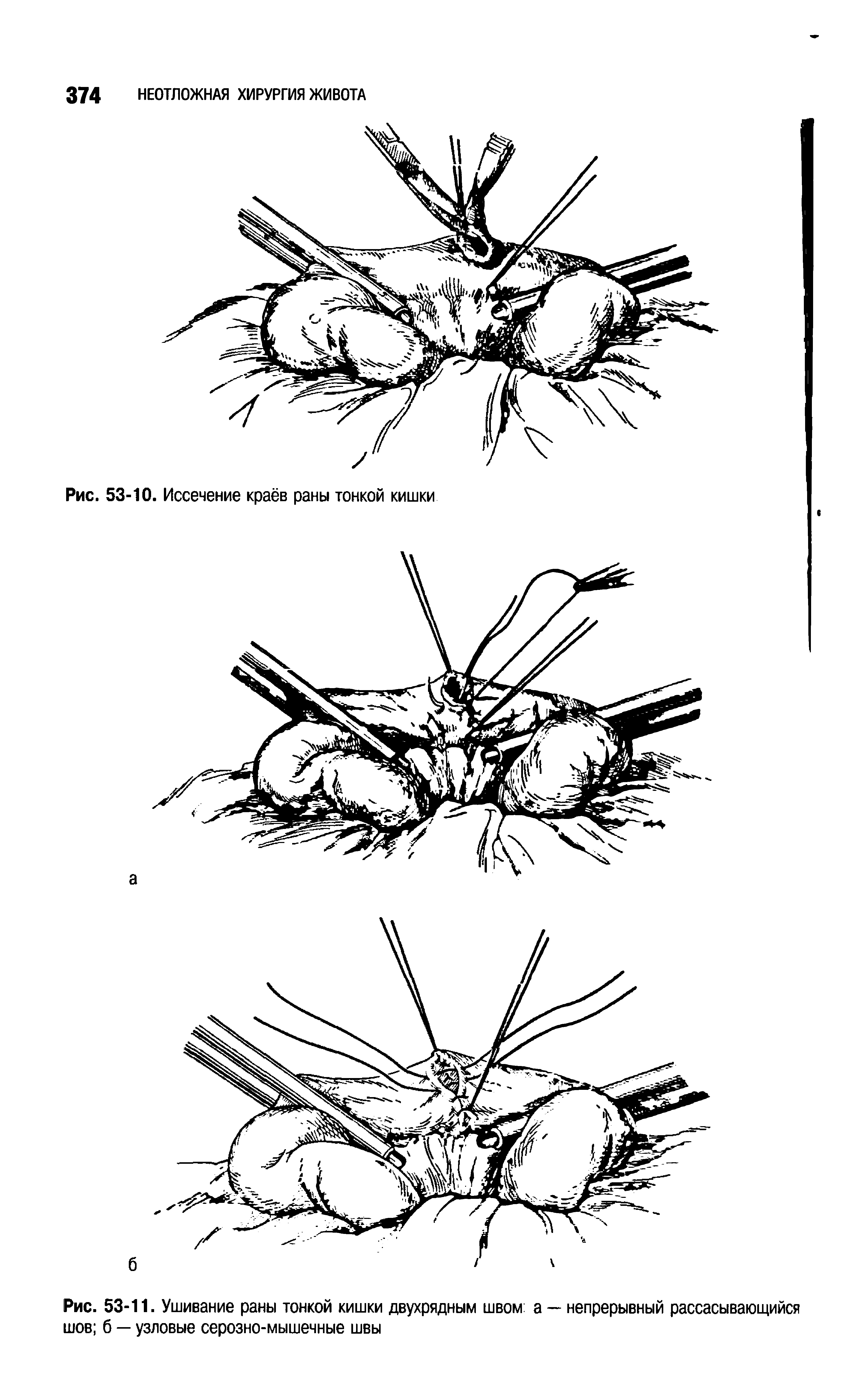 Рис. 53-11. Ушивание раны тонкой кишки двухрядным швом а — непрерывный рассасывающийся шов б — узловые серозно-мышечные швы...