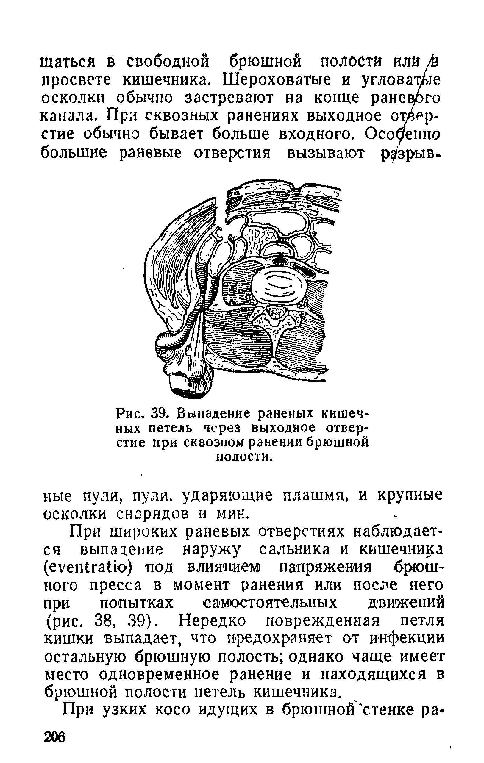 Рис. 39. Выпадение раненых кишечных петель через выходное отверстие при сквозном ранении брюшной полости.