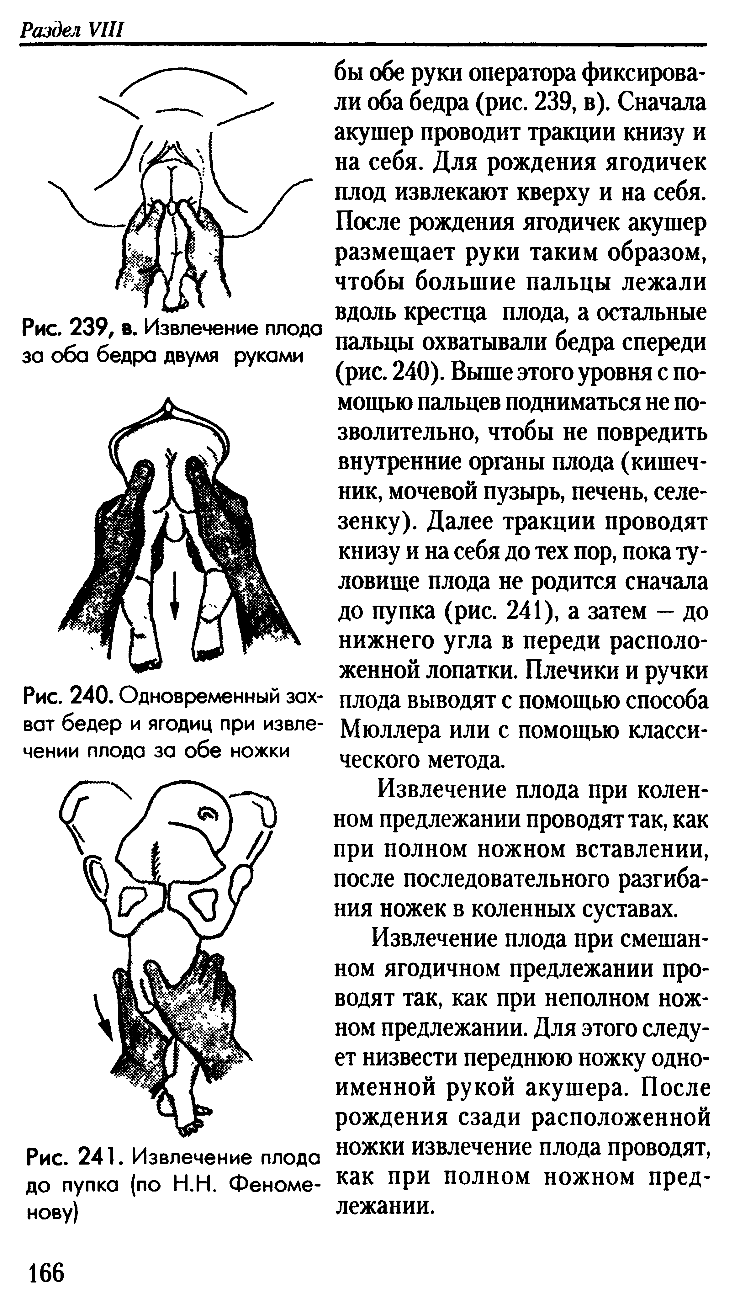 Рис. 240. Одновременный захват бедер и ягодиц при извлечении плода за обе ножки...