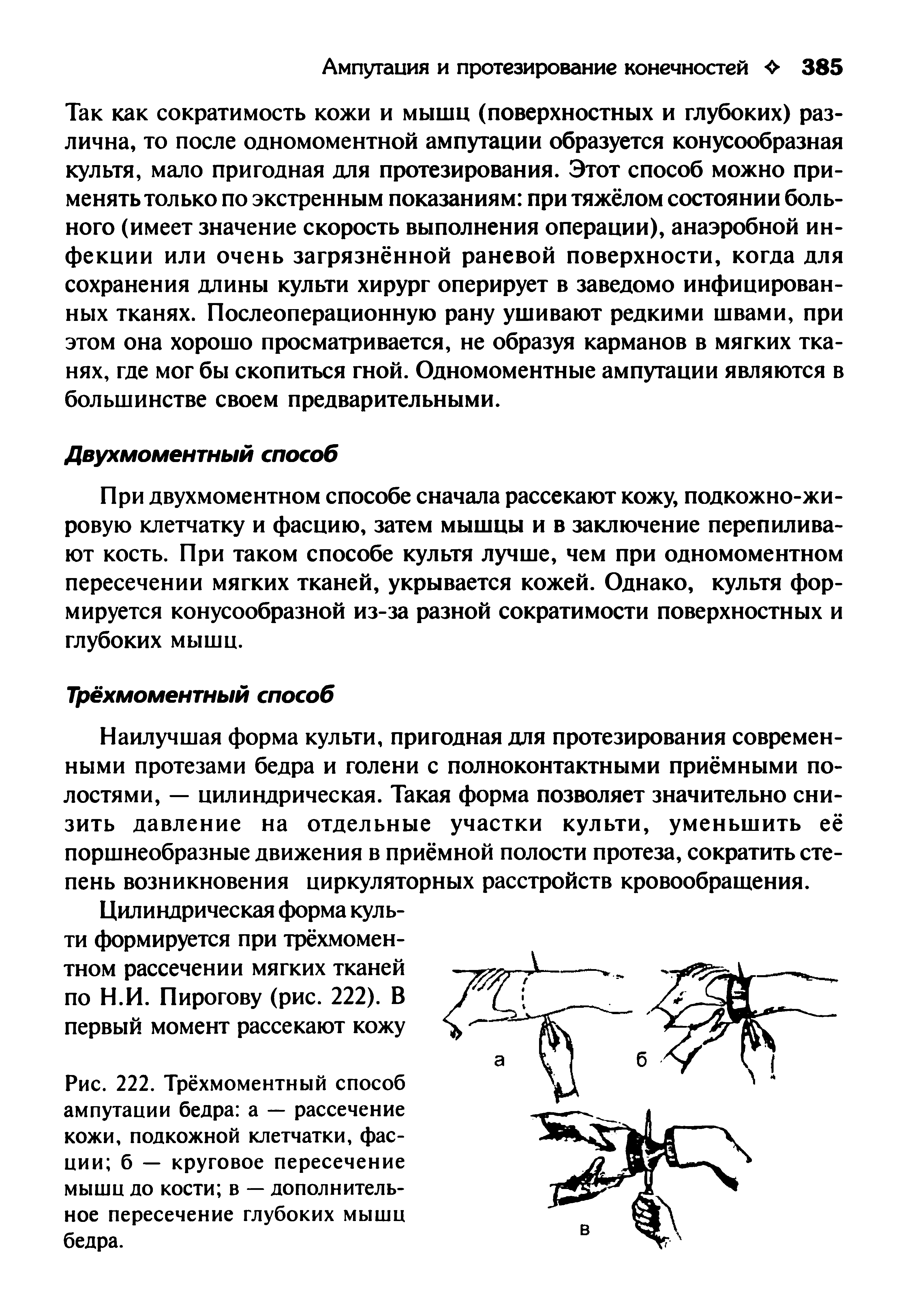 Рис. 222. Трёхмоментный способ ампутации бедра а — рассечение кожи, подкожной клетчатки, фасции б — круговое пересечение мышц до кости в — дополнительное пересечение глубоких мышц бедра.