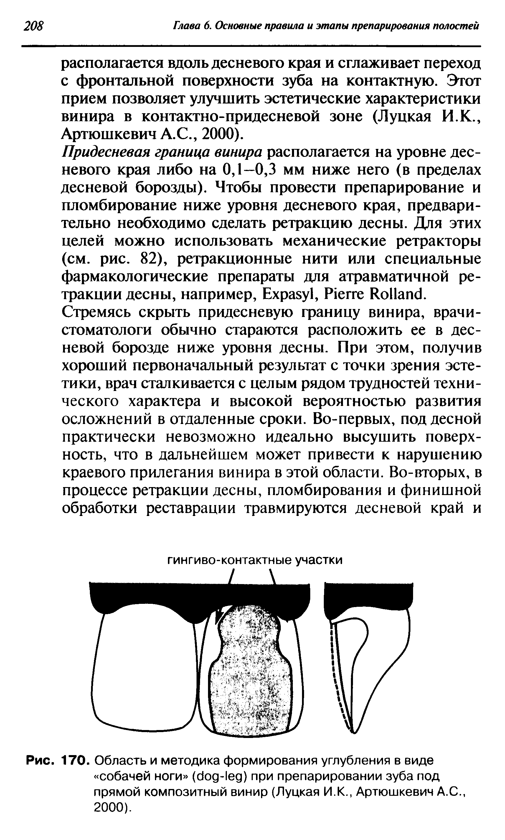 Рис. 170. Область и методика формирования углубления в виде собачей ноги ( - ) при препарировании зуба под прямой композитный винир (Луцкая И.К., Артюшкевич А.С., 2000).