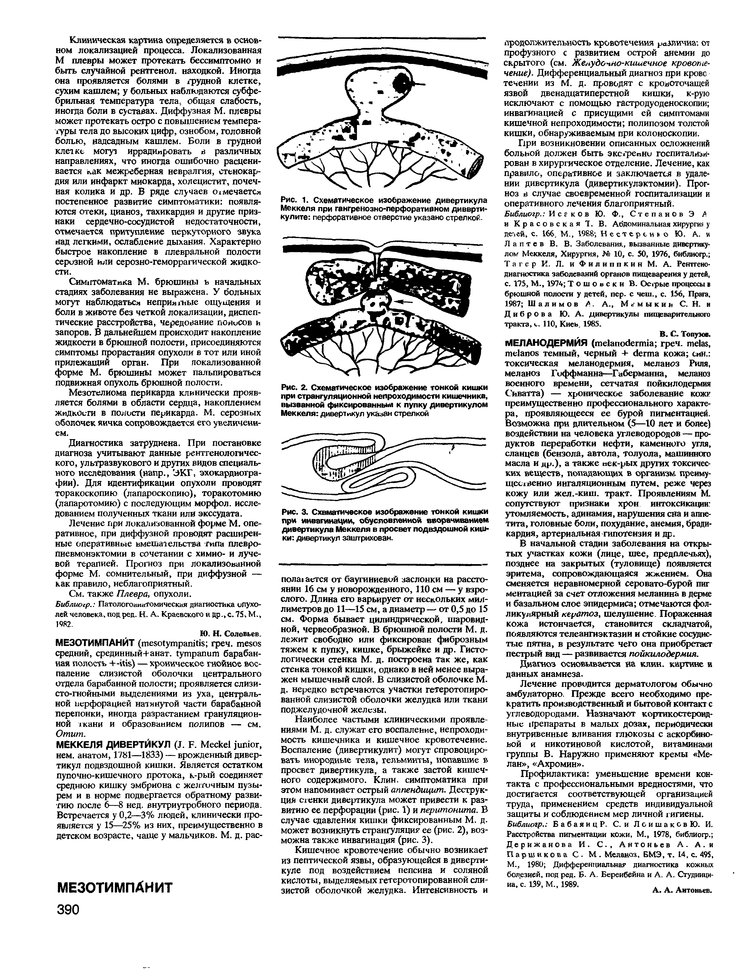 Рис. 3. Схематическое изображение тонкой кишки при инвагинации, обусловленной вворачиванием дивертикула Меккеля в просвет подвздошной кишки дивертикул заштрихован.