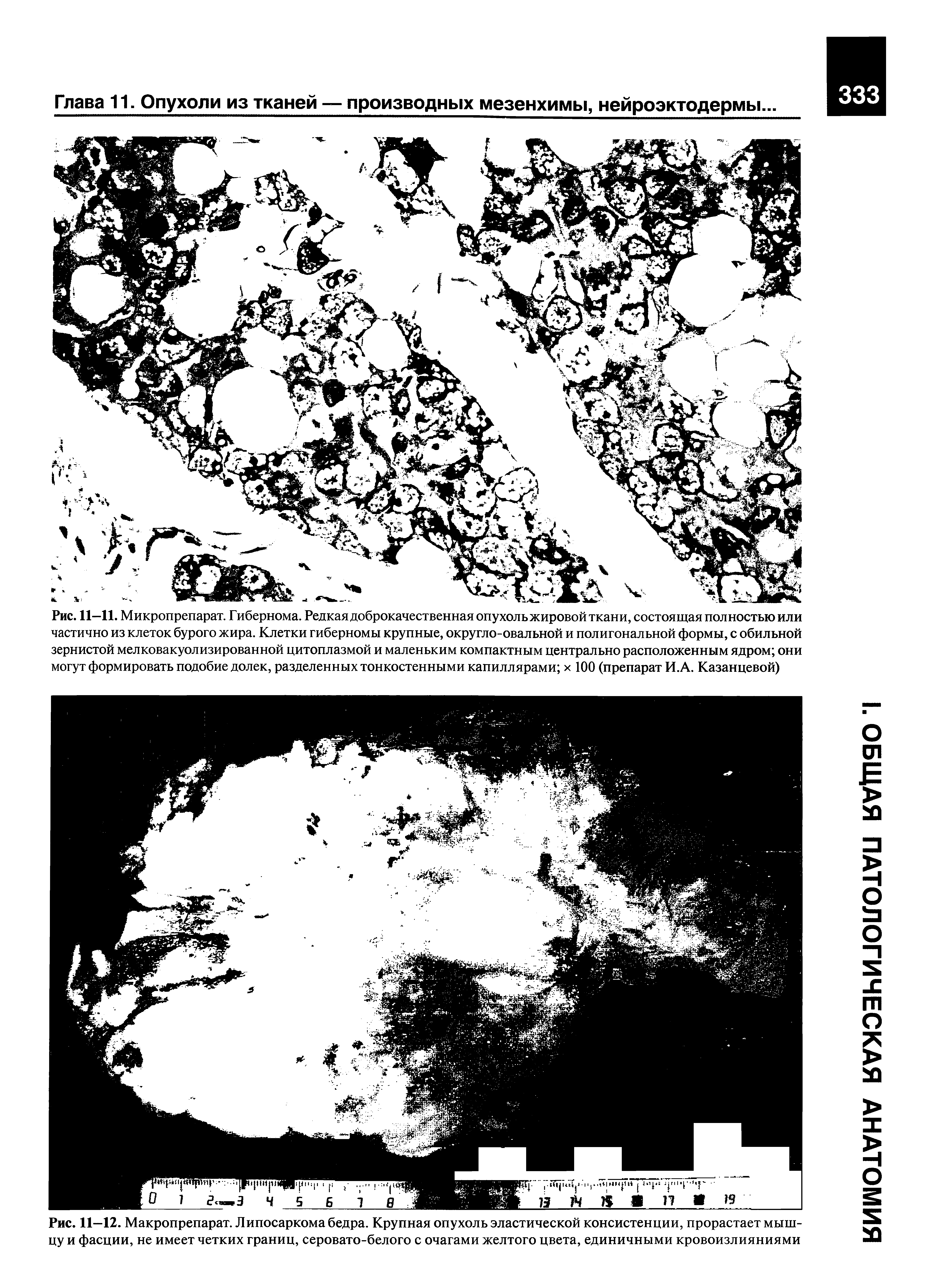 Рис. 11—12. Макропрепарат. Липосаркома бедра. Крупная опухоль эластической консистенции, прорастает мышцу и фасции, не имеет четких границ, серовато-белого с очагами желтого цвета, единичными кровоизлияниями...