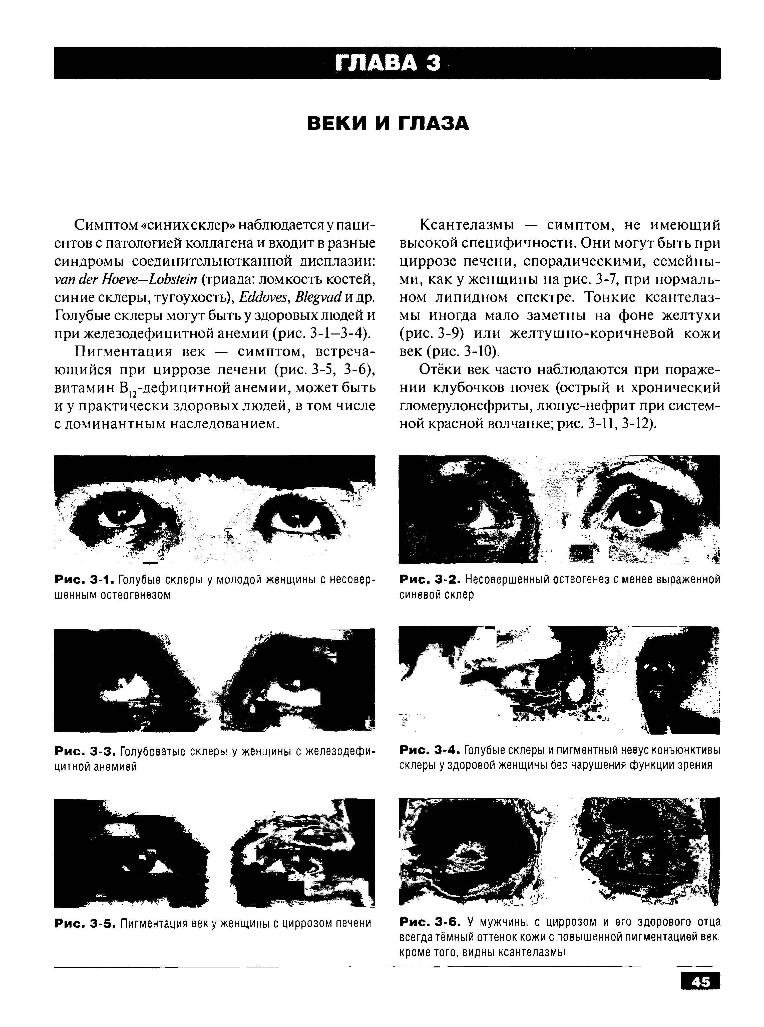 Рис. 3-4. Голубые склеры и пигментный невус конъюнктивы склеры у здоровой женщины без нарушения функции зрения...