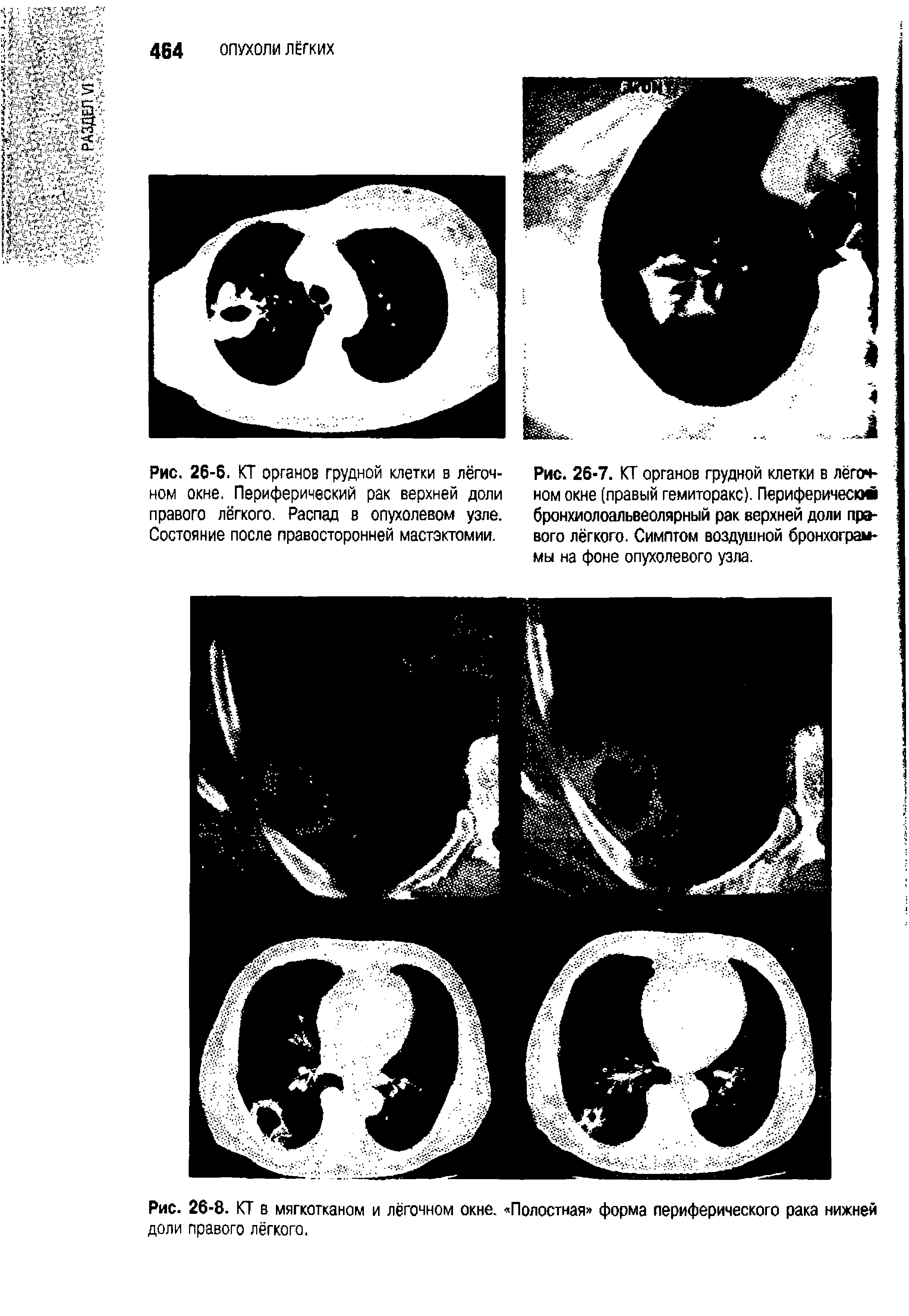 Рис. 26-8. КТ в мягкотканом и лёгочном окне. Полостная форма периферического рака нижней доли правого лёгкого.