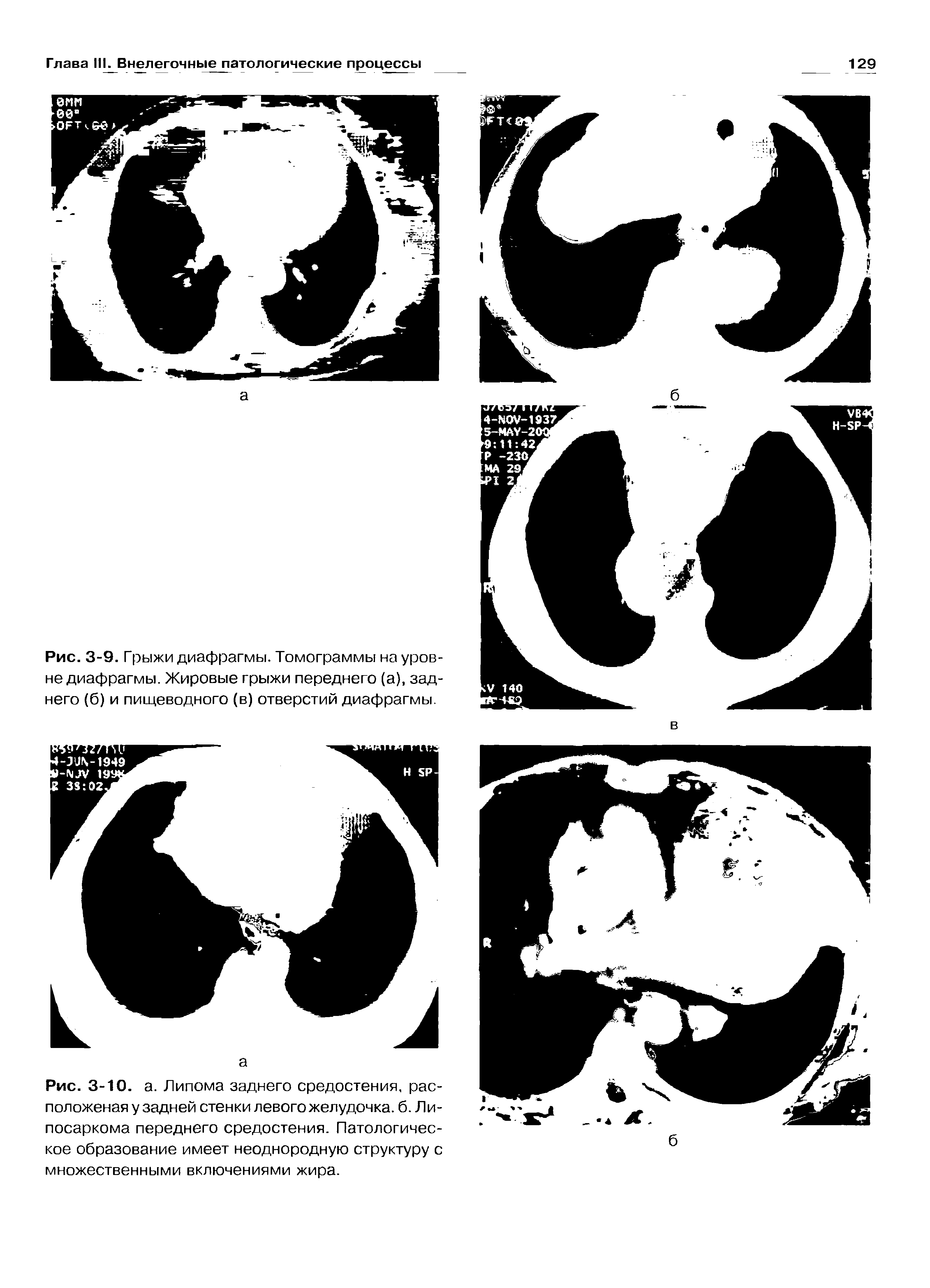 Рис. 3-9. Г рыжи диафрагмы. Томограммы на уровне диафрагмы. Жировые грыжи переднего (а), заднего (б) и пищеводного (в) отверстий диафрагмы.