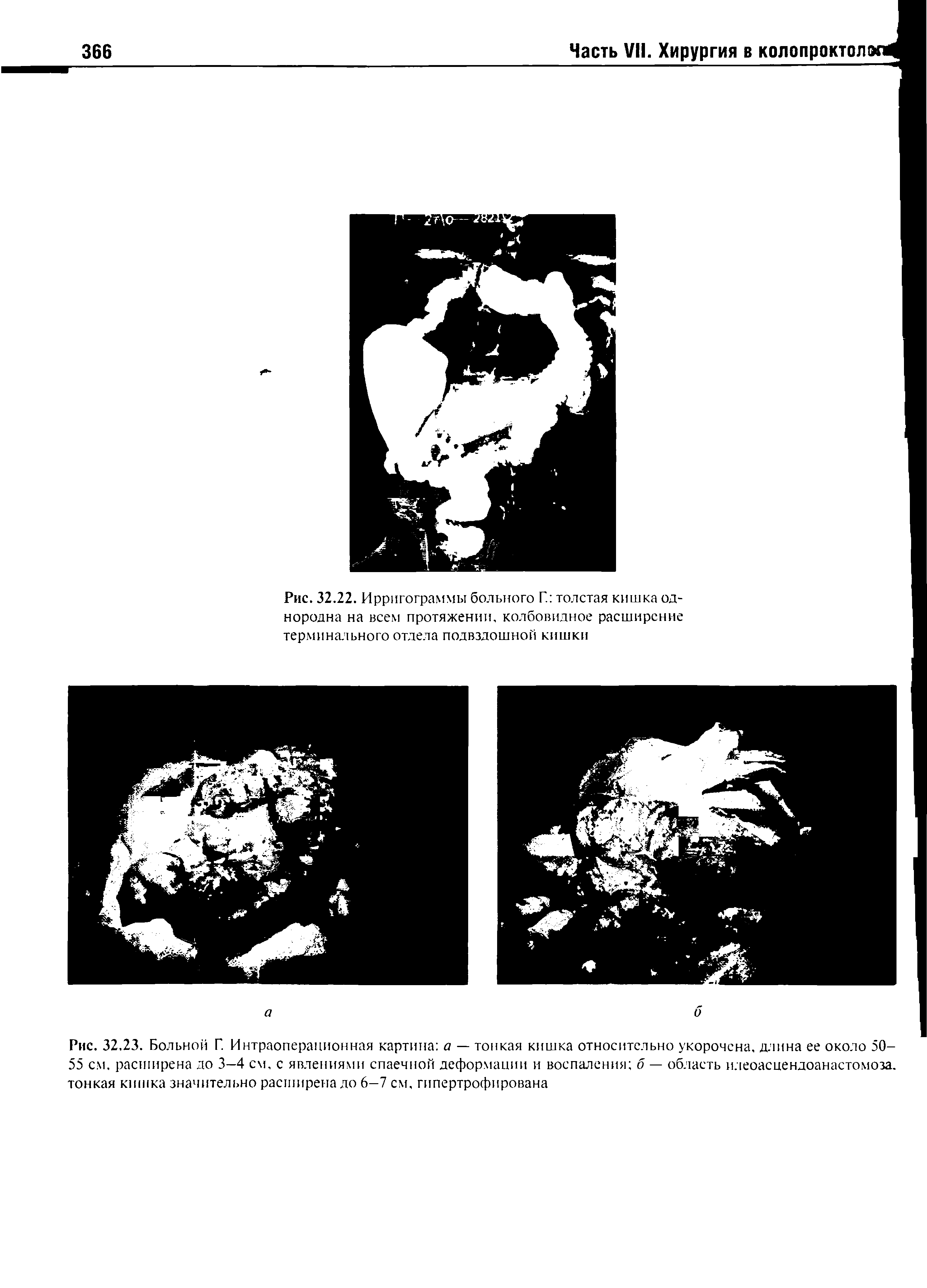 Рис. 32.23. Больной Г. Интраоперационная картина а — тонкая кишка относительно укорочена, длина ее около 50-55 см. расширена до 3—4 см, с явлениями спаечной деформации и воспаления б — область илеоасцендоанастомоза, тонкая кишка значительно расширена до 6—7 см, гипертрофирована...