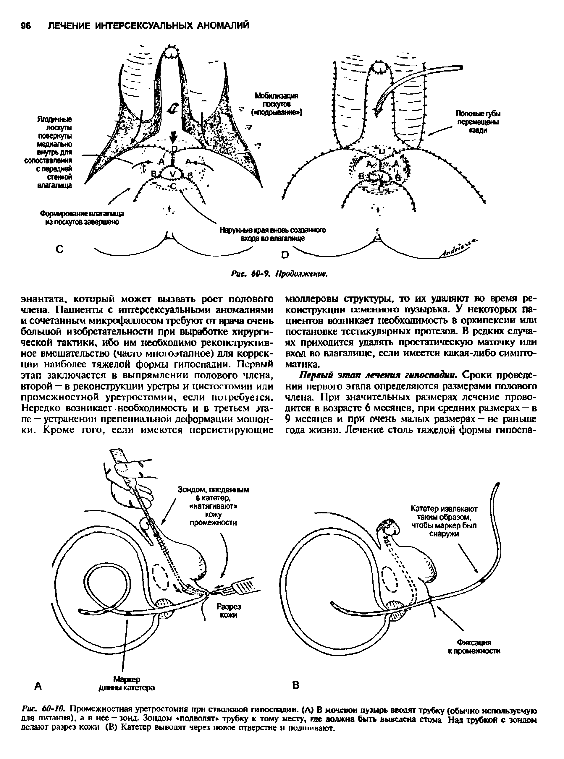 Рис. 60-10. Промежностная уретростомия при стволовой гипоспадии. (Л) В мочевой пузырь вводят трубку (обычно используемую для питания), а в нее — зонд. Зондом подводят трубку к тому месту, где должна быть выведена стома Над трубкой с зондом делают разрез кожи (В) Катетер выводят через новое отверстие и подшивают.