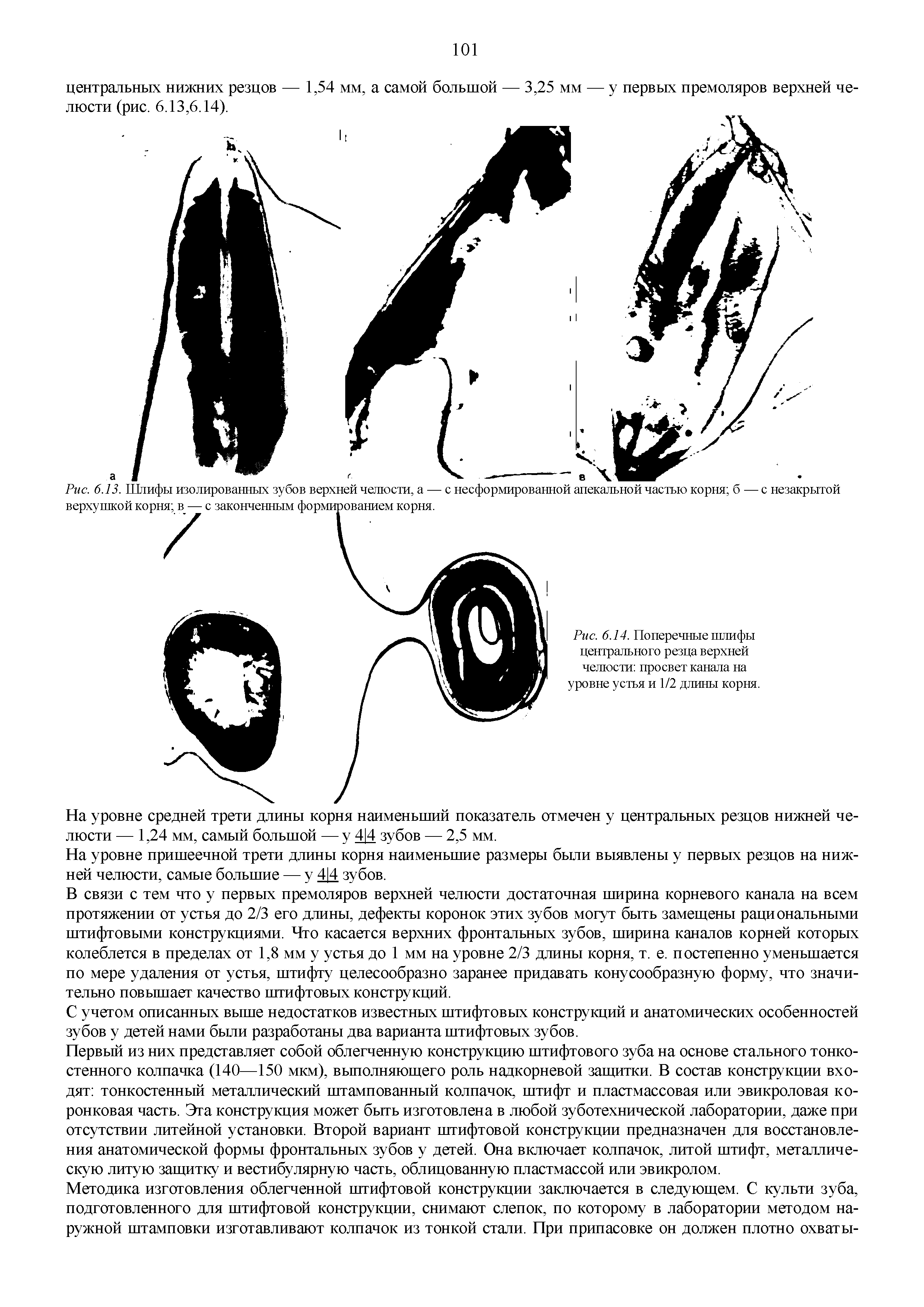 Рис. 6.14. Поперечные шлифы центрального резца верхней челюсти просвет канала на уровне устья и 1/2 длины корня.