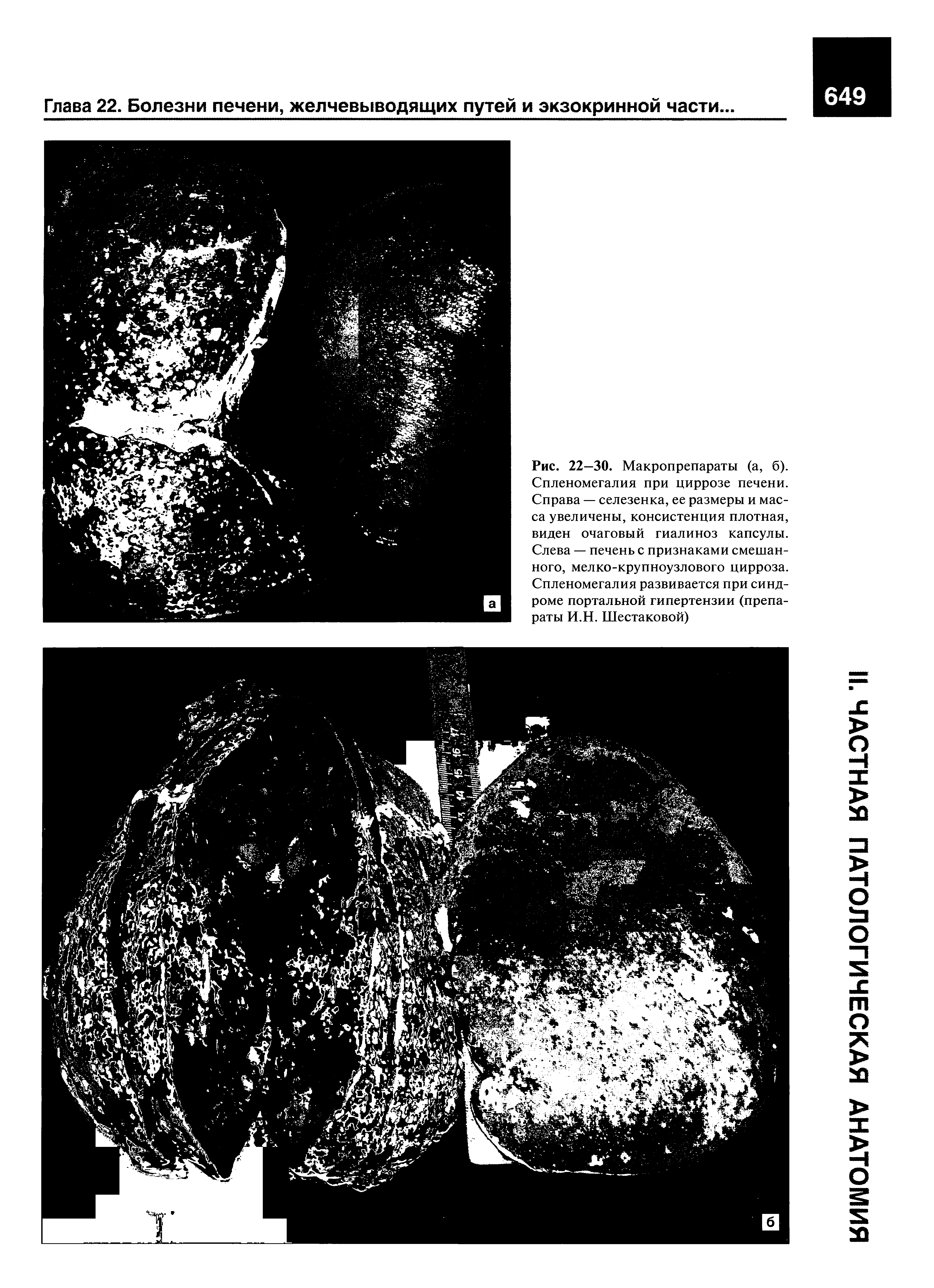 Рис. 22—30. Макропрепараты (а, б). Спленомегалия при циррозе печени. Справа — селезенка, ее размеры и масса увеличены, консистенция плотная, виден очаговый гиалиноз капсулы. Слева — печень с признаками смешанного, мелко-крупноузлового цирроза. Спленомегалия развивается при синдроме портальной гипертензии (препараты И.Н. Шестаковой)...