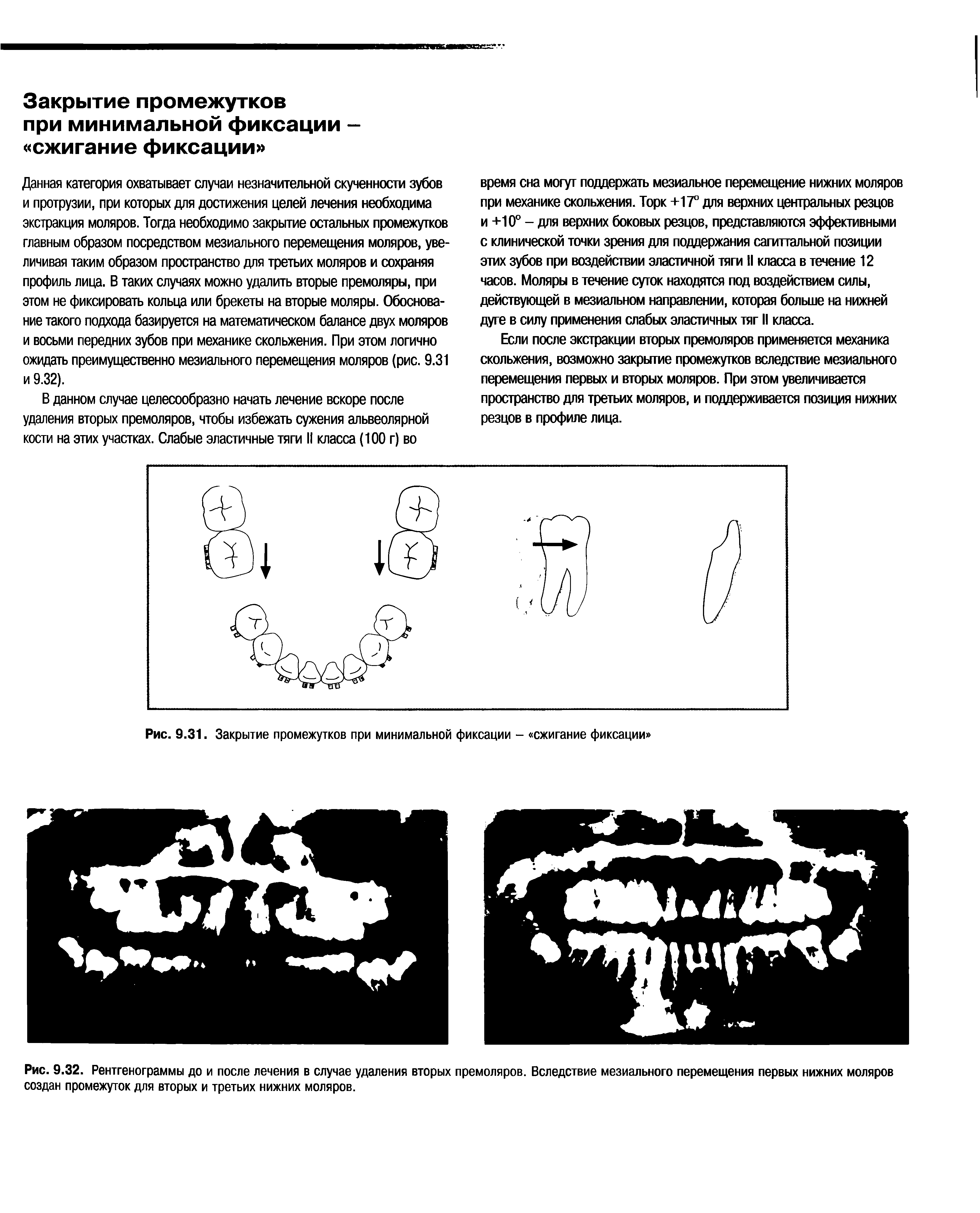 Рис. 9.32. Рентгенограммы до и после лечения в случае удаления вторых премоляров. Вследствие мезиального перемещения первых нижних моляров создан промежуток для вторых и третьих нижних моляров.