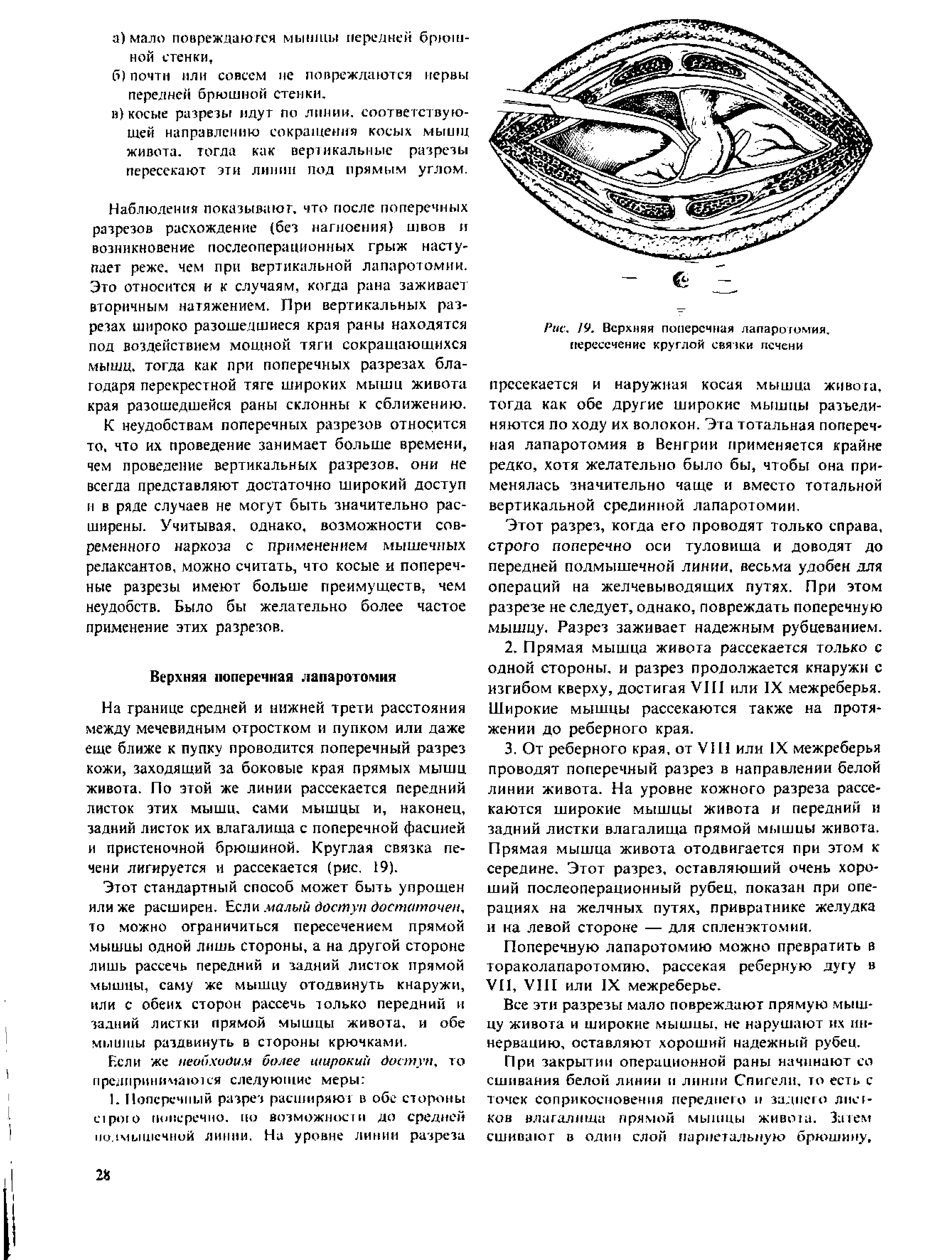 Рис. 19. Верхняя поперечная лапаротомия, пересечение круглой связки печени...