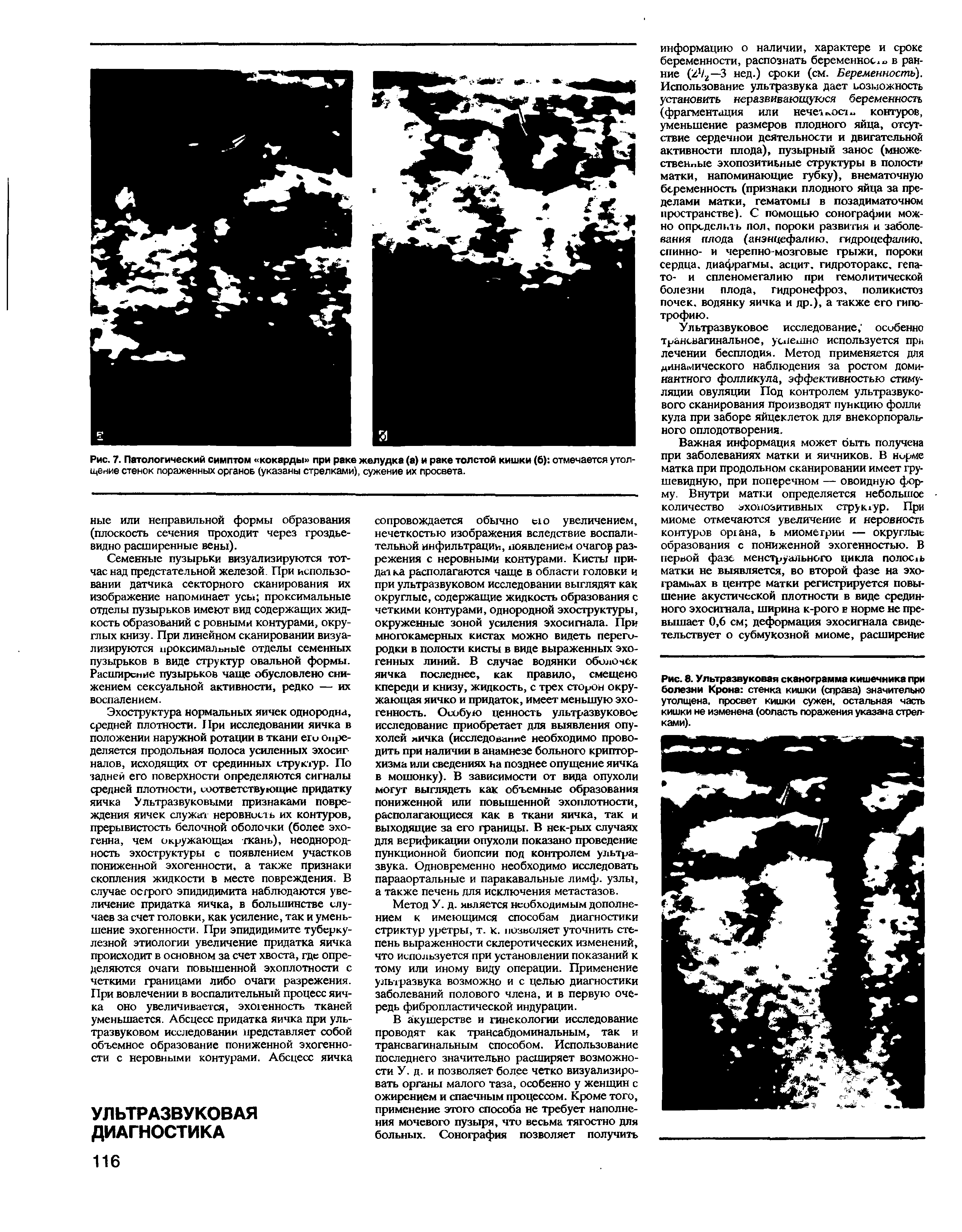 Рис. 8. Ультразвуковая сканограмма кишечника при болезни Крона стенка кишки (справа) значительно утолщена, просвет кишки сужен, остальная часть кишки не изменена (ооласть поражения указана стрелками).