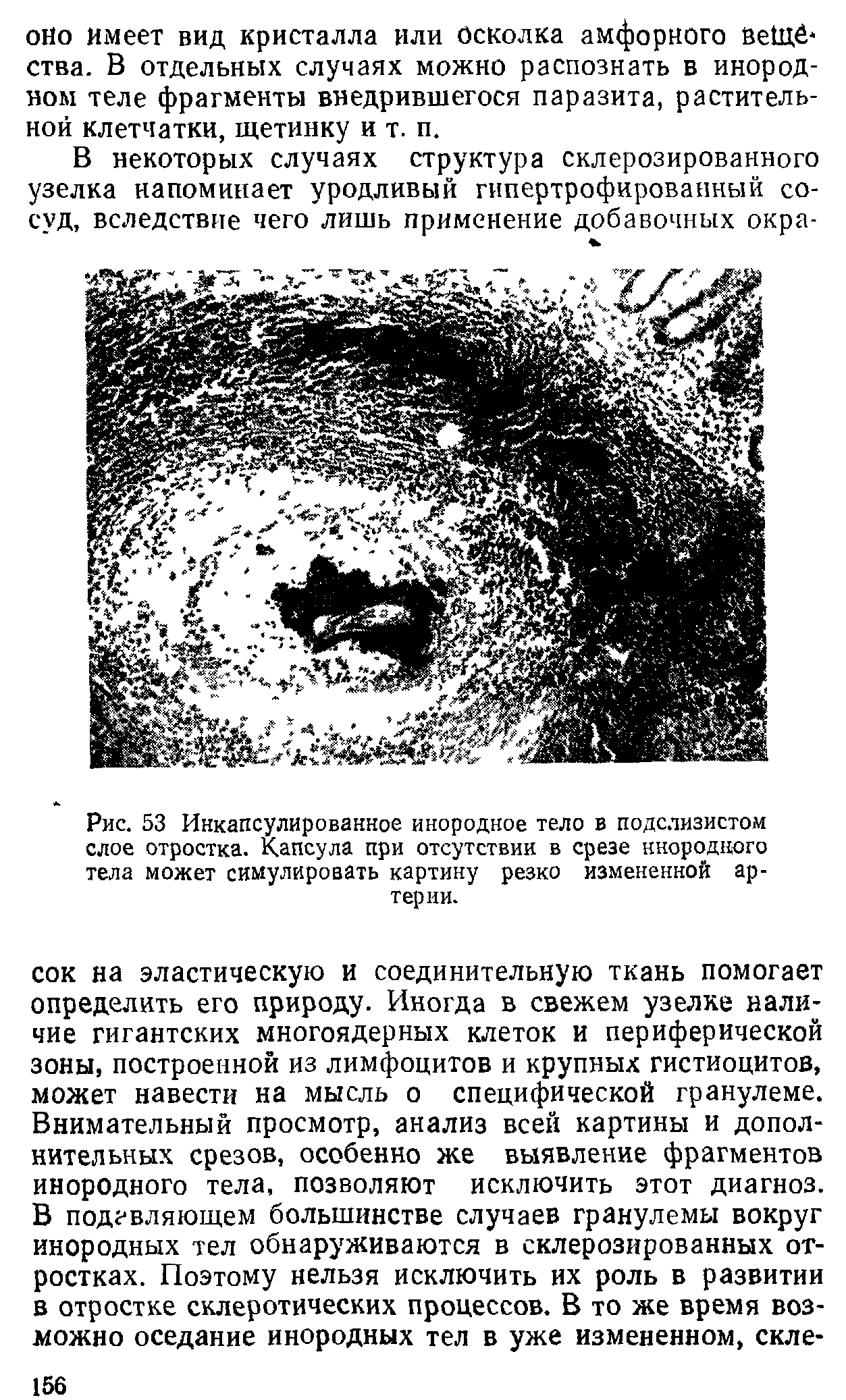 Рис. 53 Инкапсулированное инородное тело в подслизистом слое отростка. Капсула при отсутствии в срезе инородного тела может симулировать картину резко измененной артерии.