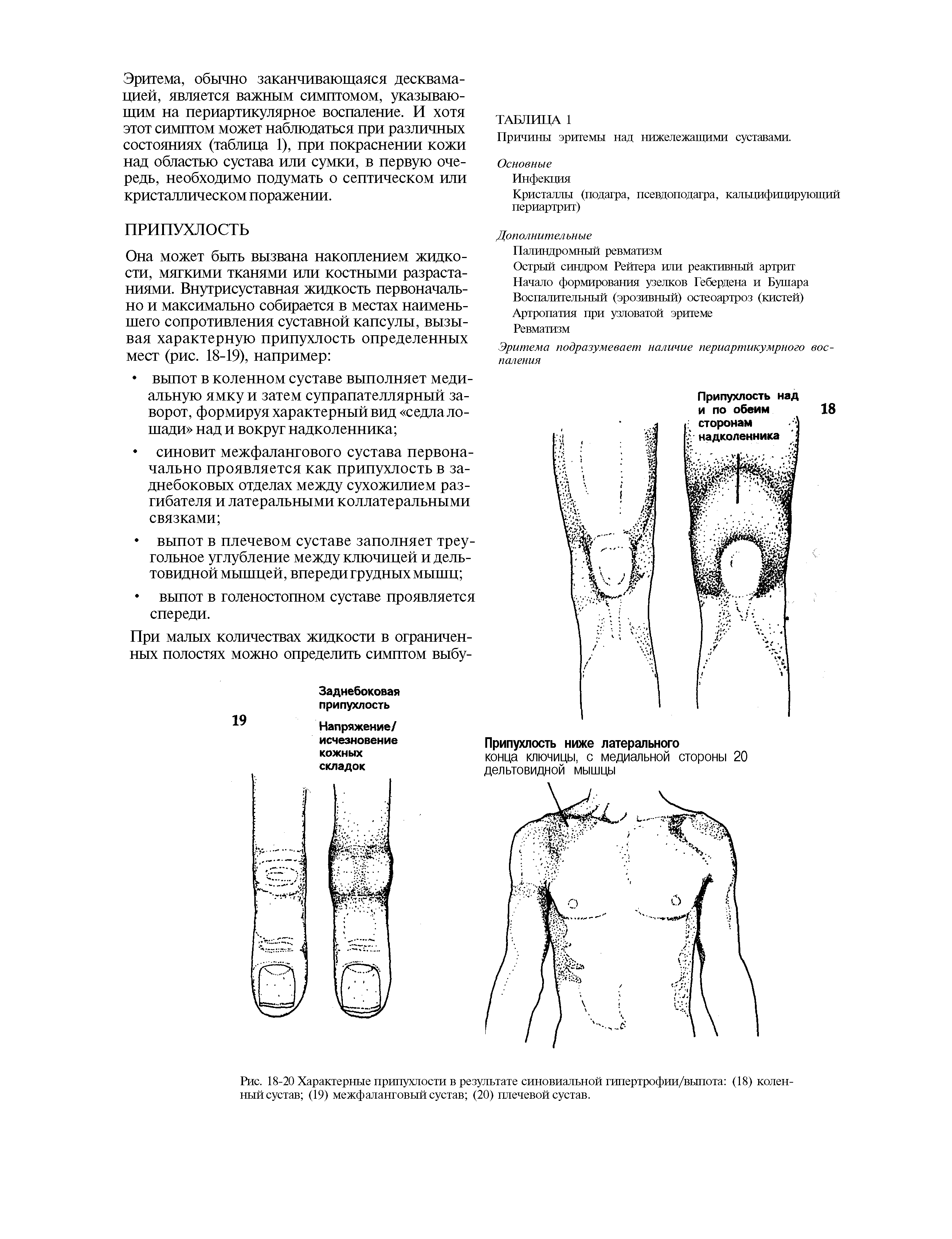 Рис. 18-20 Характерные припухлости в результате синовиальной гипертрофии/выпота (18) коленный сустав (19) межфаланговый сустав (20) плечевой сустав.