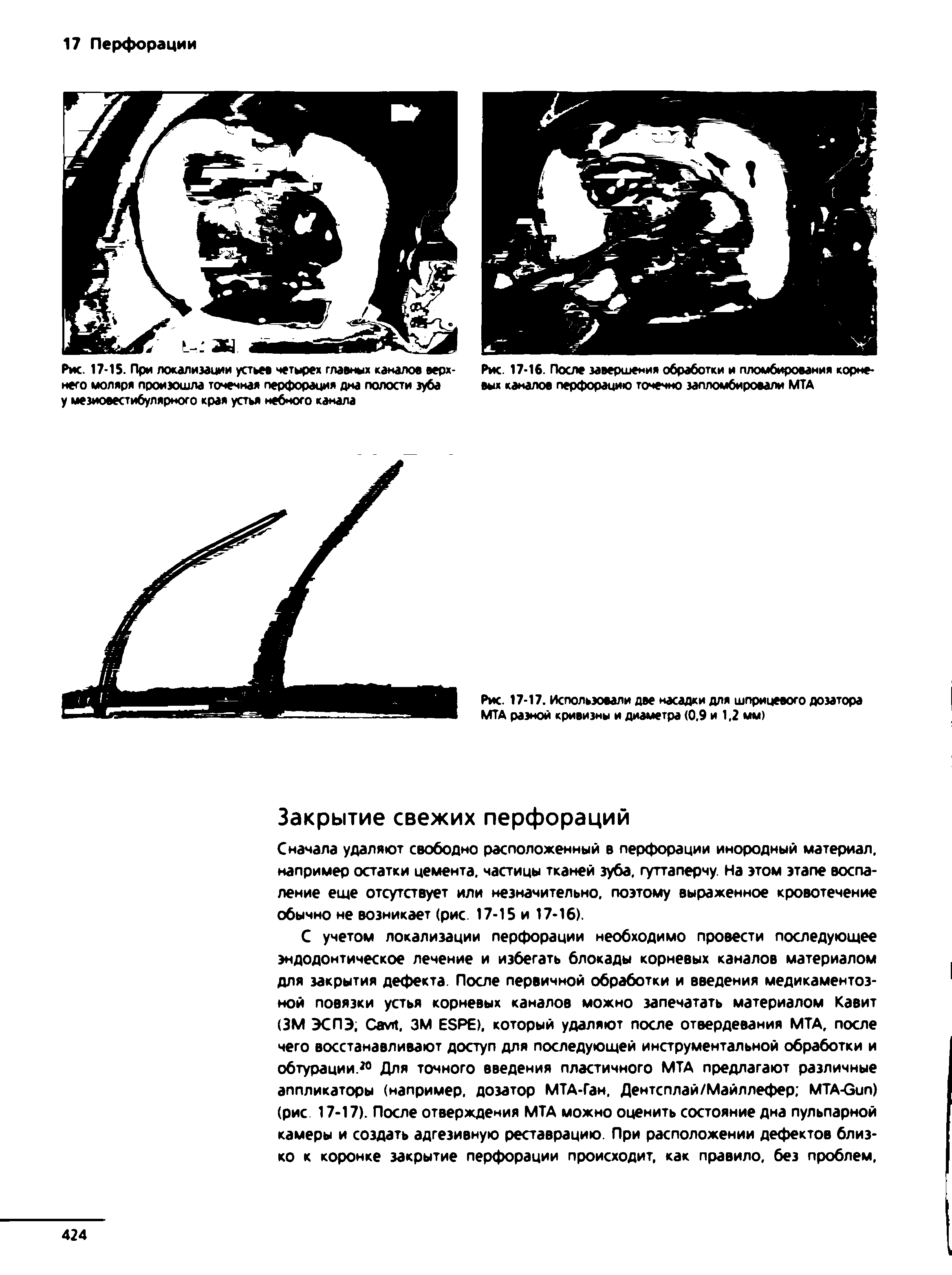 Рис. 17-16. После завершения обработки и пломбирования корневых каналов перфорацию точечно запломбировали МТА...