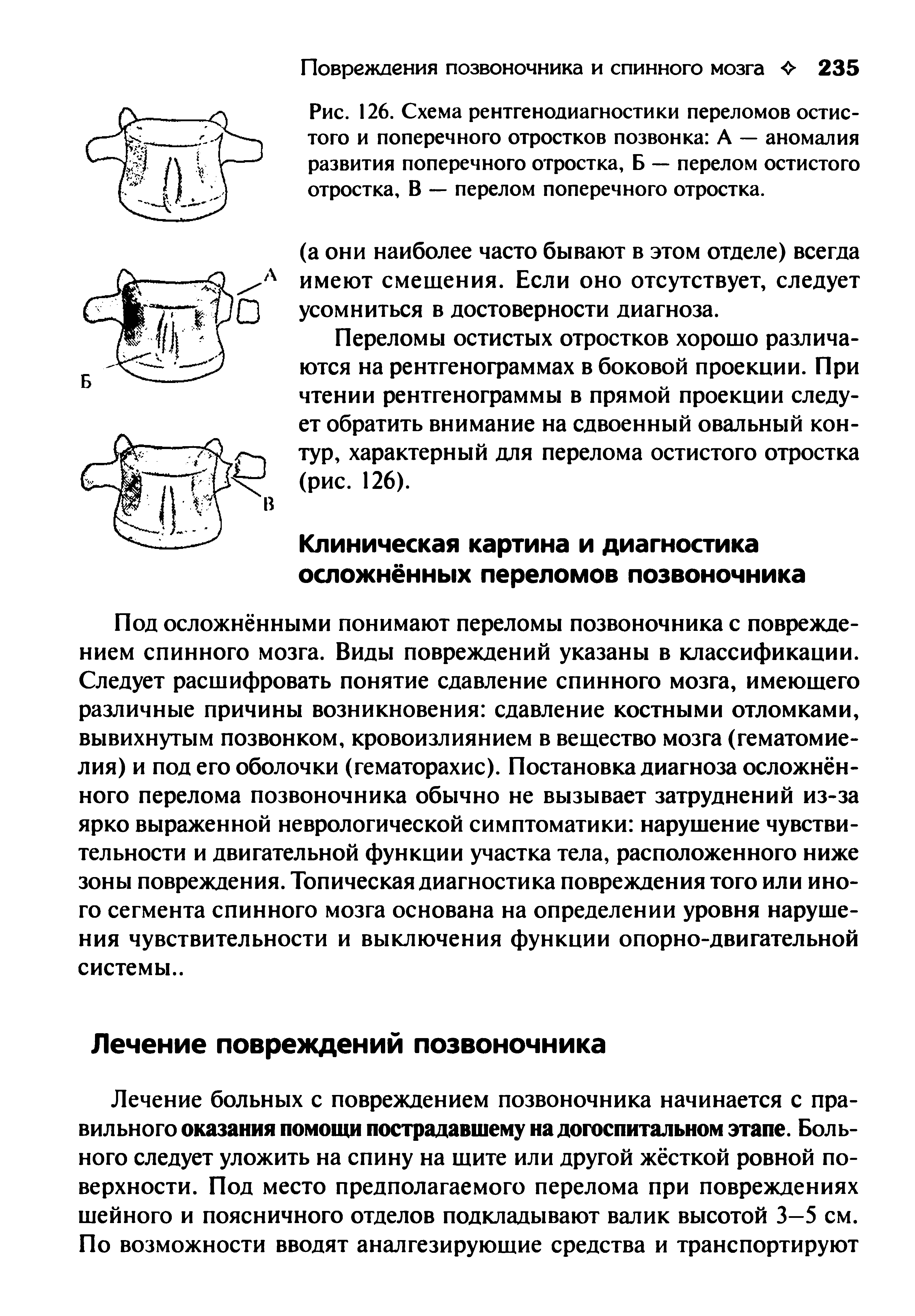 Рис. 126. Схема рентгенодиагностики переломов остистого и поперечного отростков позвонка А — аномалия развития поперечного отростка, Б — перелом остистого отростка, В — перелом поперечного отростка.