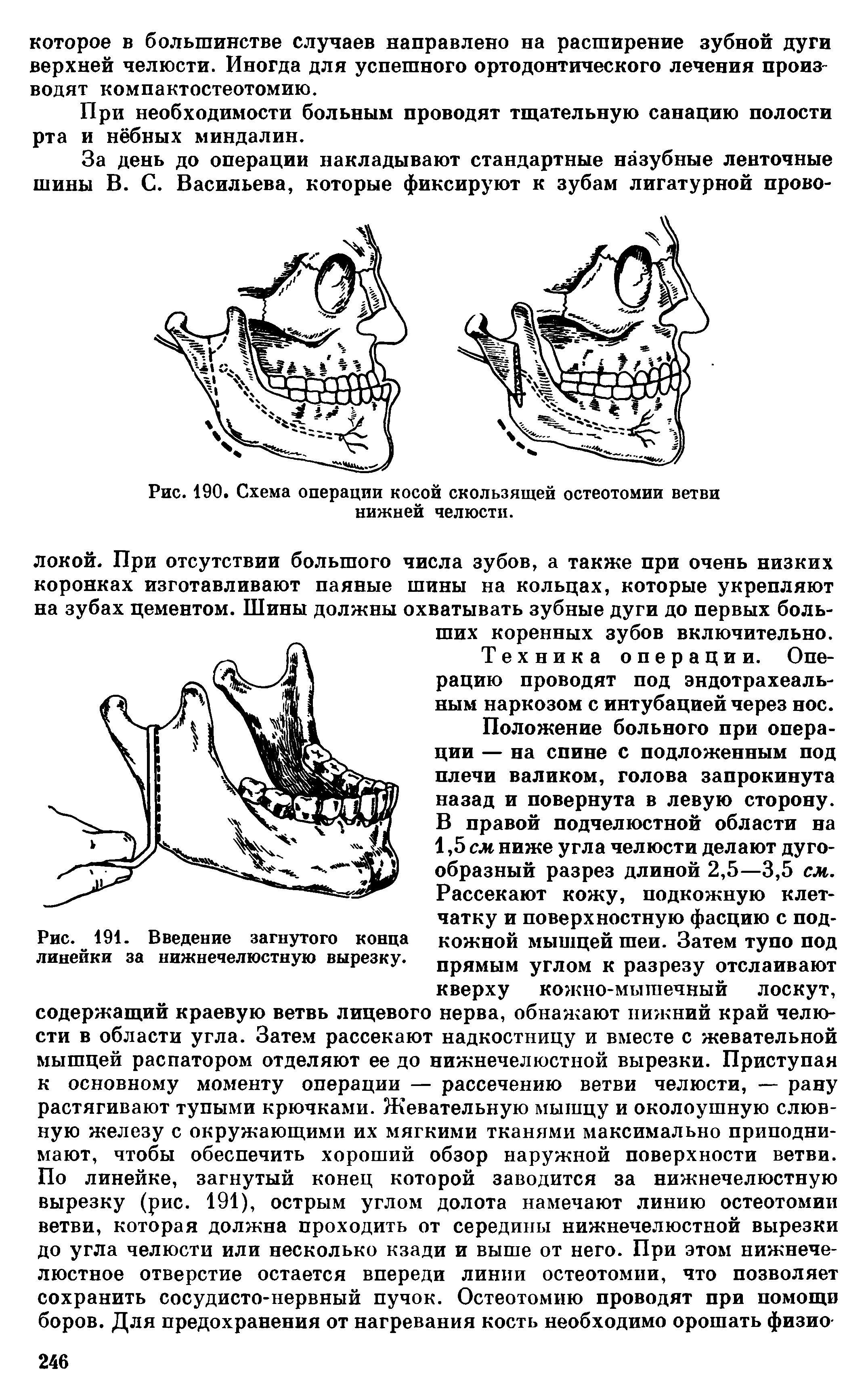 Рис. 191. Введение загнутого конца линейки за нижнечелюстную вырезку.