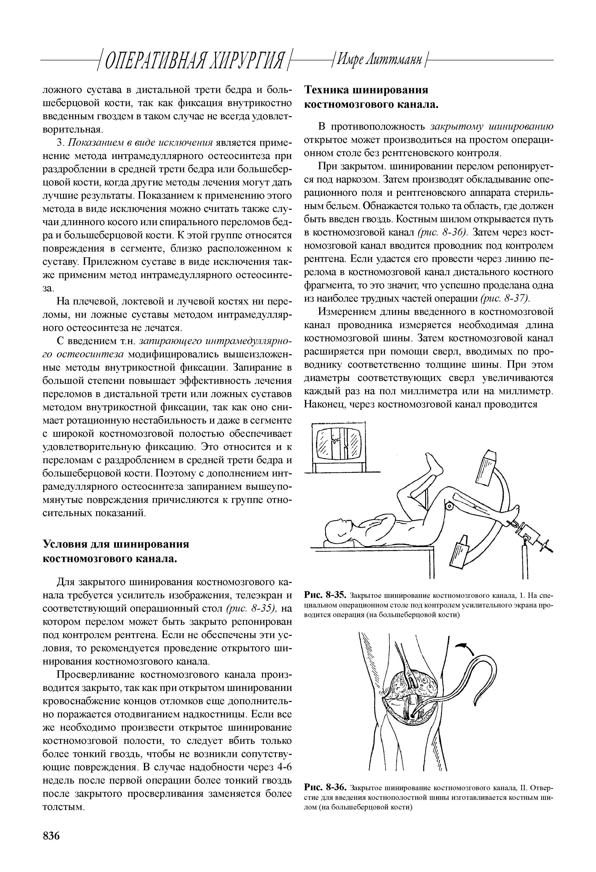 Рис. 8-35. Закрытое шинирование костномозгового канала, 1. На спе-циальном операционном столе под контролем усилительного экрана проводится операция (на большеберцовой кости)...