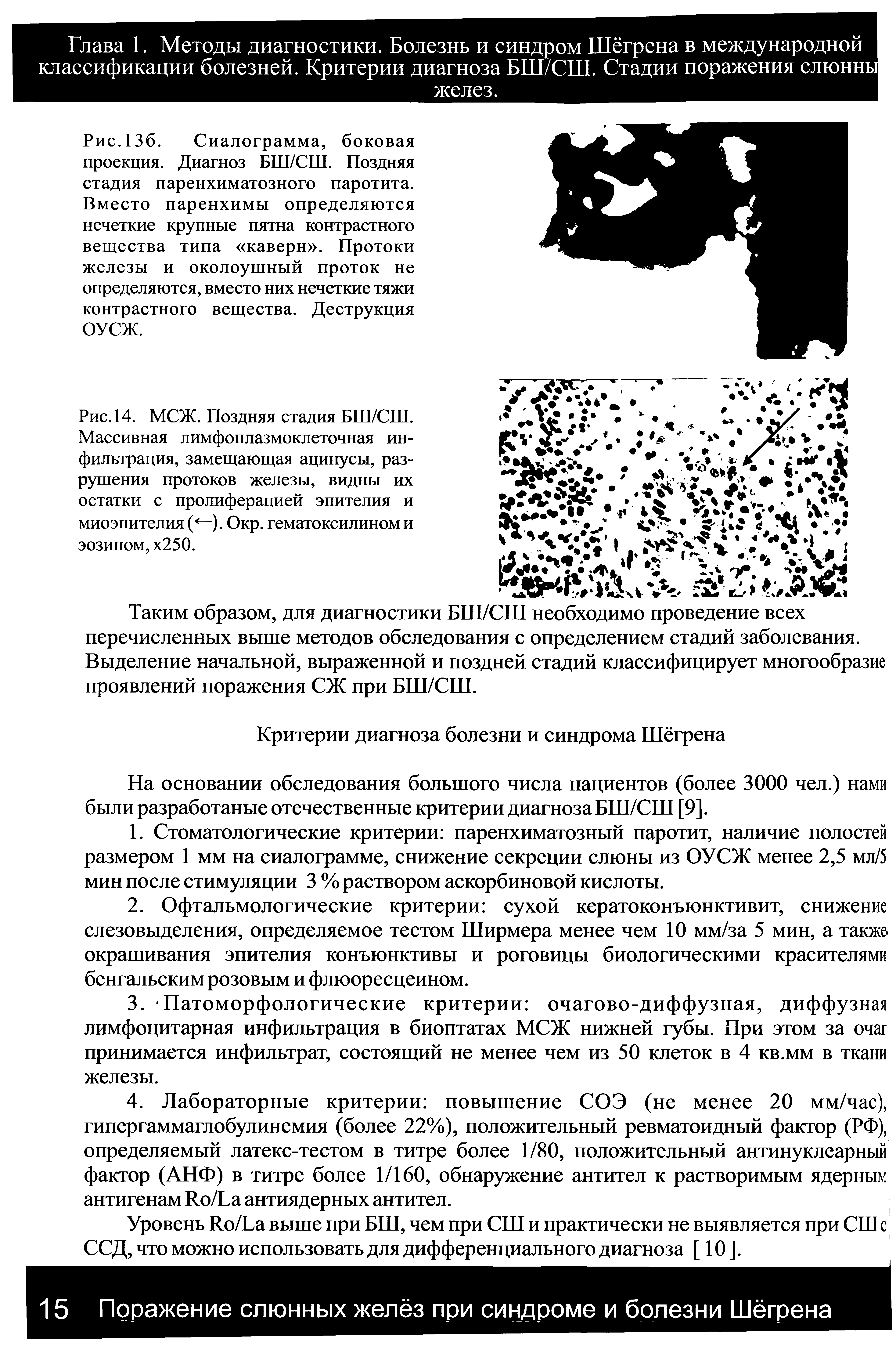 Рис. 14. МСЖ. Поздняя стадия БШ/СШ. Массивная лимфоплазмоклеточная инфильтрация, замещающая ацинусы, разрушения протоков железы, видны их остатки с пролиферацией эпителия и миоэпителия (<—). Окр. гематоксилином и эозином, х250.