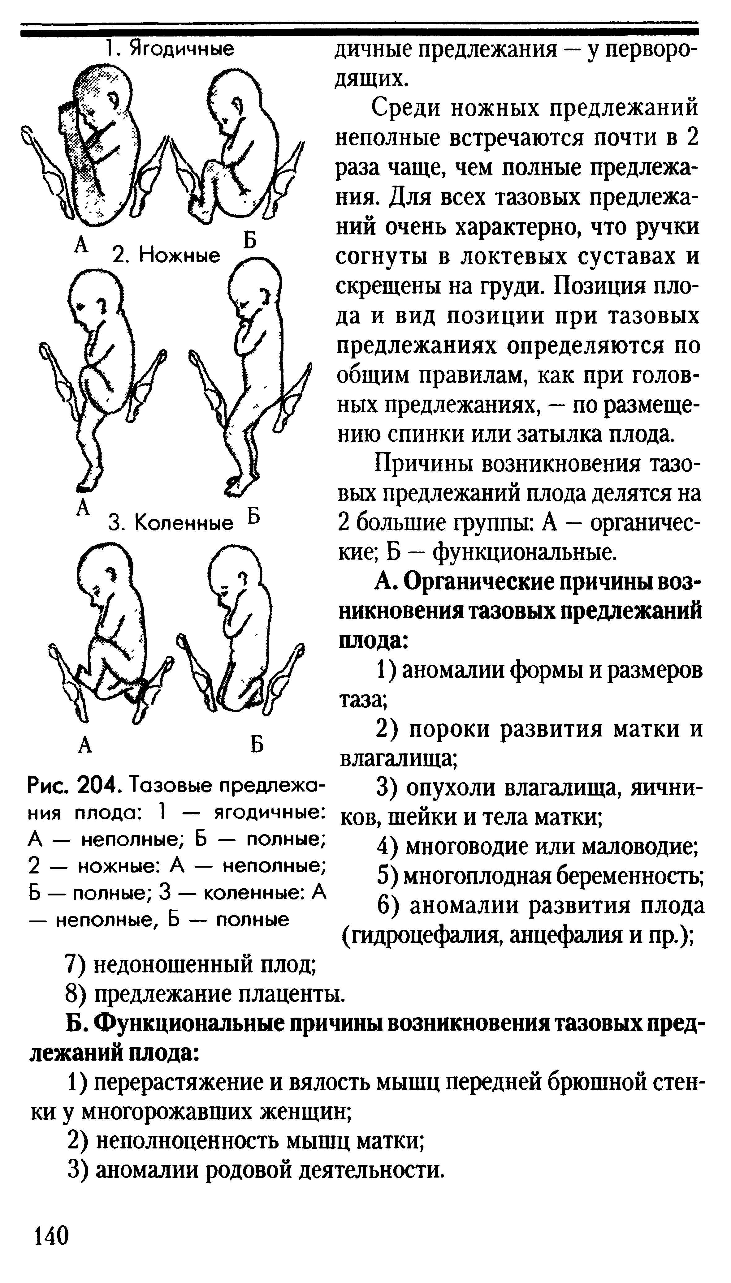 Рис. 204. Тазовые предлежания плода 1 — ягодичные А — неполные Б — полные 2 — ножные А — неполные Б — полные 3 — коленные А — неполные, Б — полные...