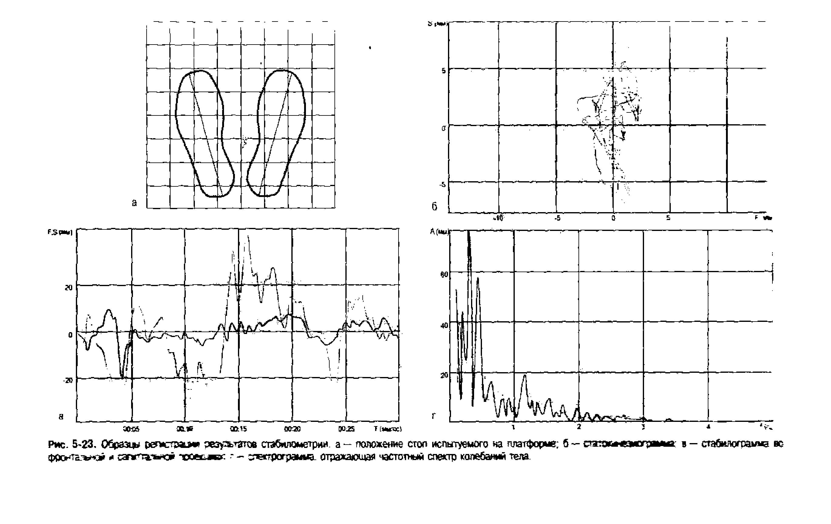 Рис. 5 23, Образд (дострашя резузьтжв стэбилометрии. а - положение стоп испытуемого на платформе б — сэджмэктршш в - ста лжхрамвд вс Доонта. доэй сапг ьгсй псоеьлвас — стеггрограмда. отражающая частотным спектр колебаний тела...