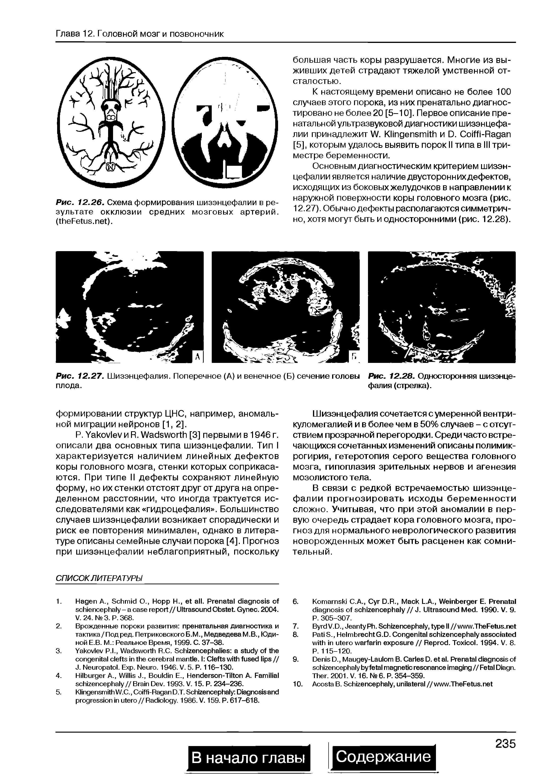 Рис. 12.27. Шизэнцефалия. Поперечное (А) и венечное (Б) сечение головы плода.