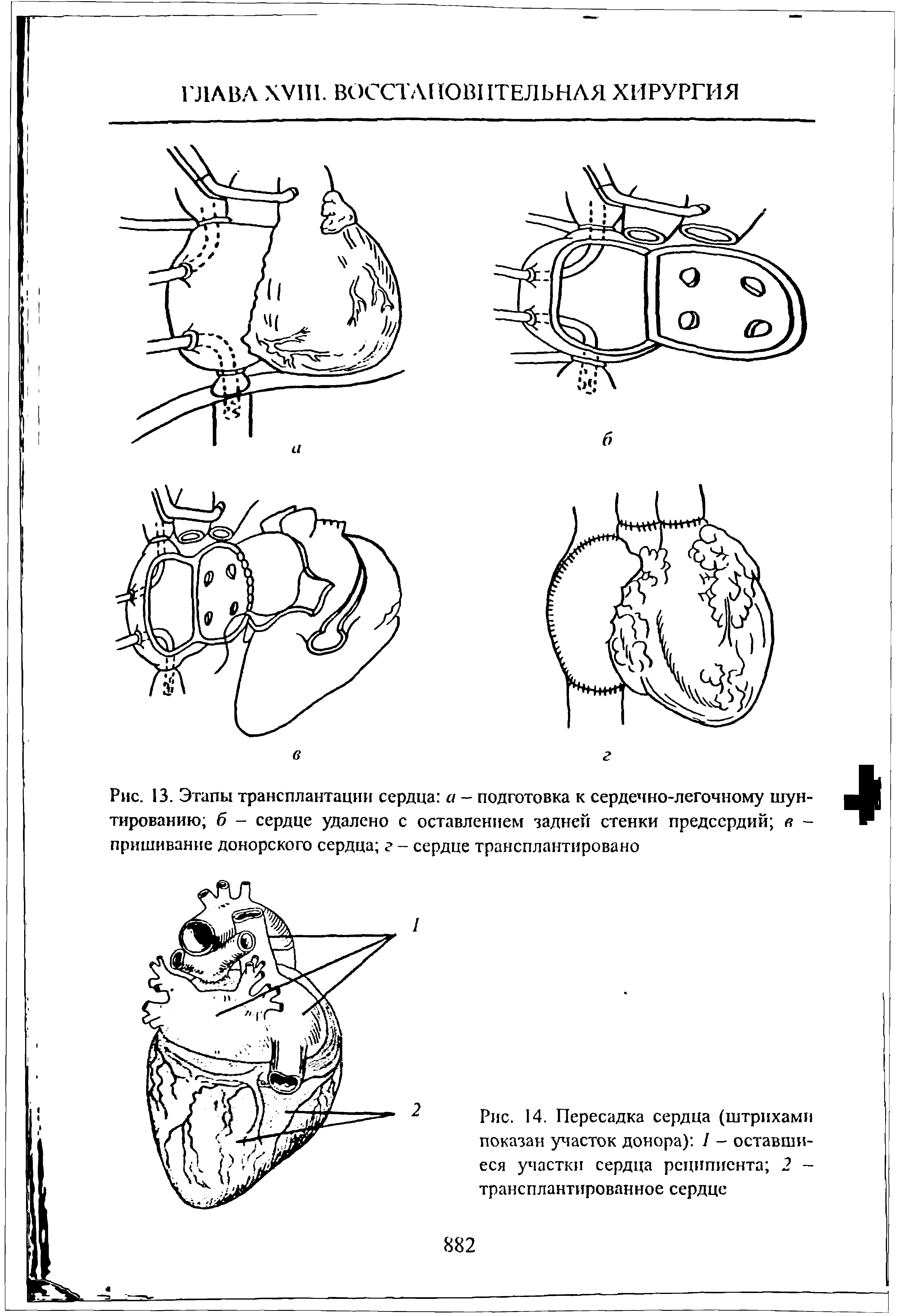 Рис. 13. Этапы трансплантации сердца а - подготовка к сердечно-легочному шунтированию б - сердце удалено с оставлением задней стенки предсердий я -пришивание донорского сердца г - сердце трансплантировано...