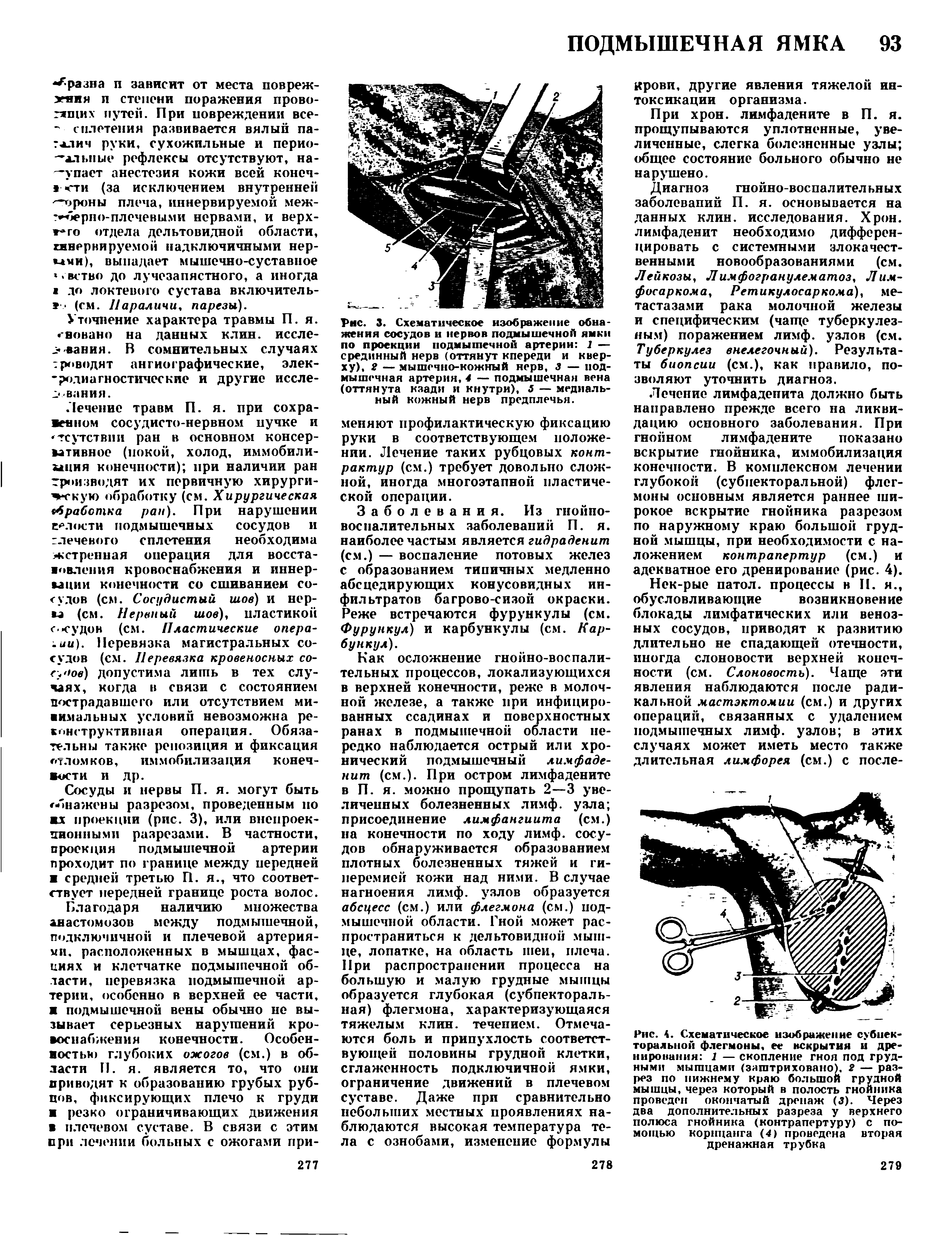 Рис. 3. Схематическое изображение обнажения сосудов в нервов подмышечной ямки по проекции подмышечной артерии 1 — срединный нерв (оттянут кпереди и кверху), 2 — мышечно-кожный нерв, 3 — подмышечная артерия, 4 — подмышечная вена (оттянута кзади и кнутри), 5 — медиальный кожный нерв предплечья.