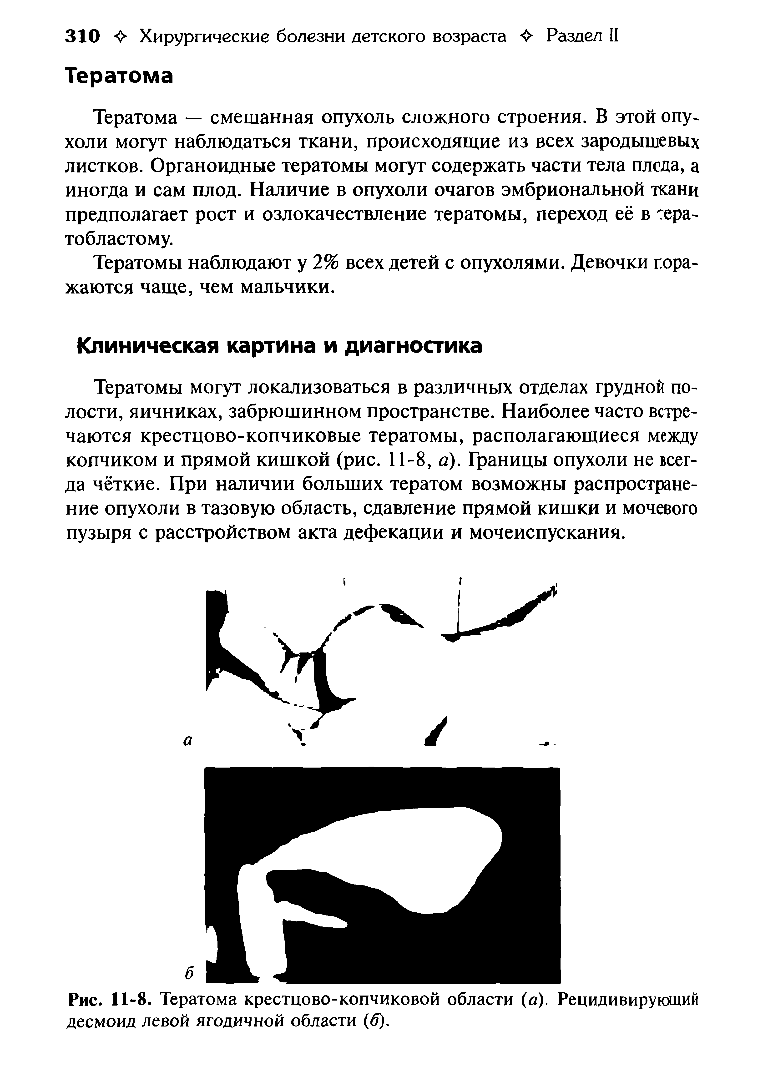 Рис. 11-8. Тератома крестцово-копчиковой области (а). Рецидивирующий десмоид левой ягодичной области (б).