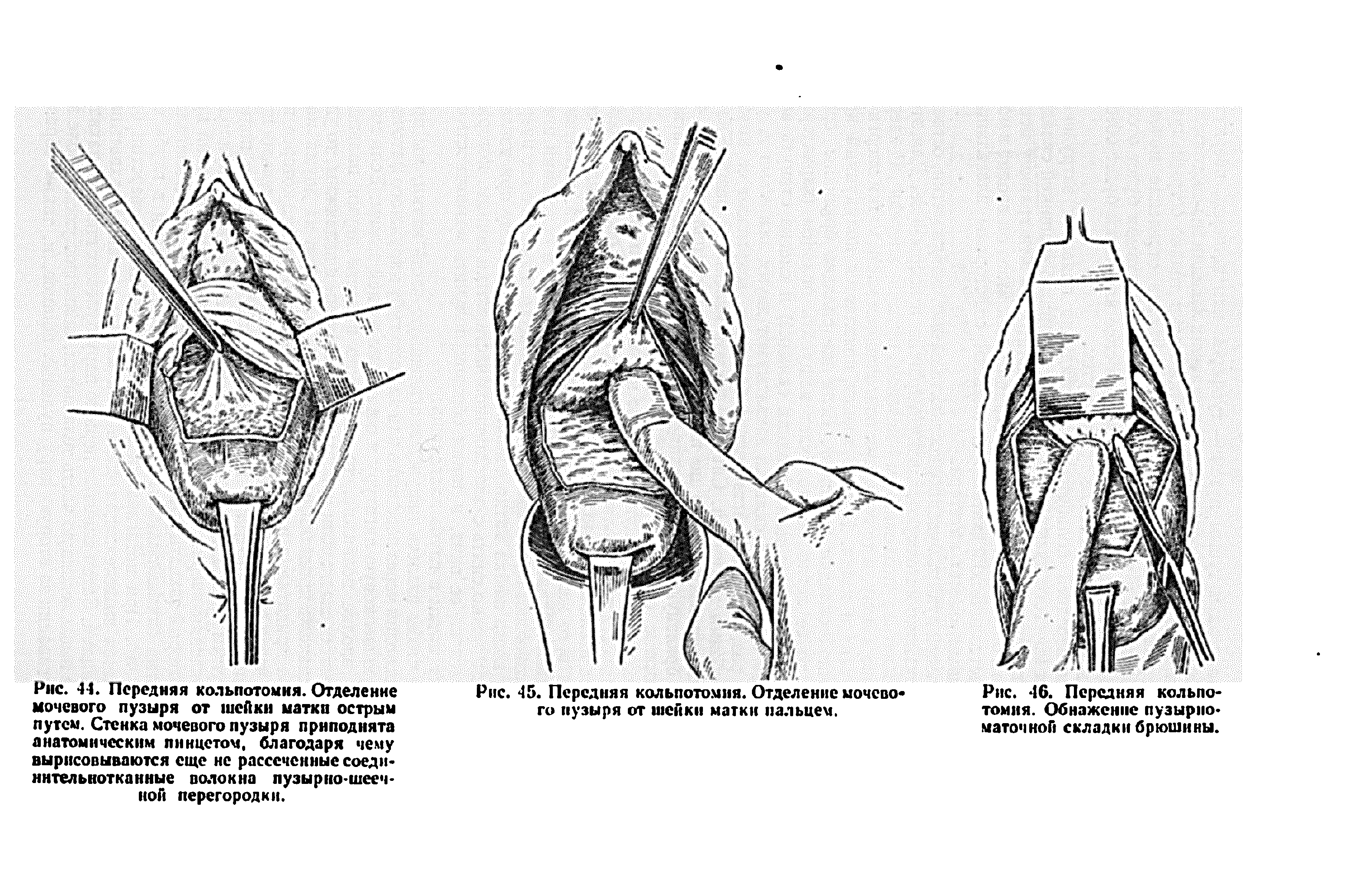 Рис. 45. Передняя кольпотомня. Отделение мочевого пузыря от шейки матки пальцем.
