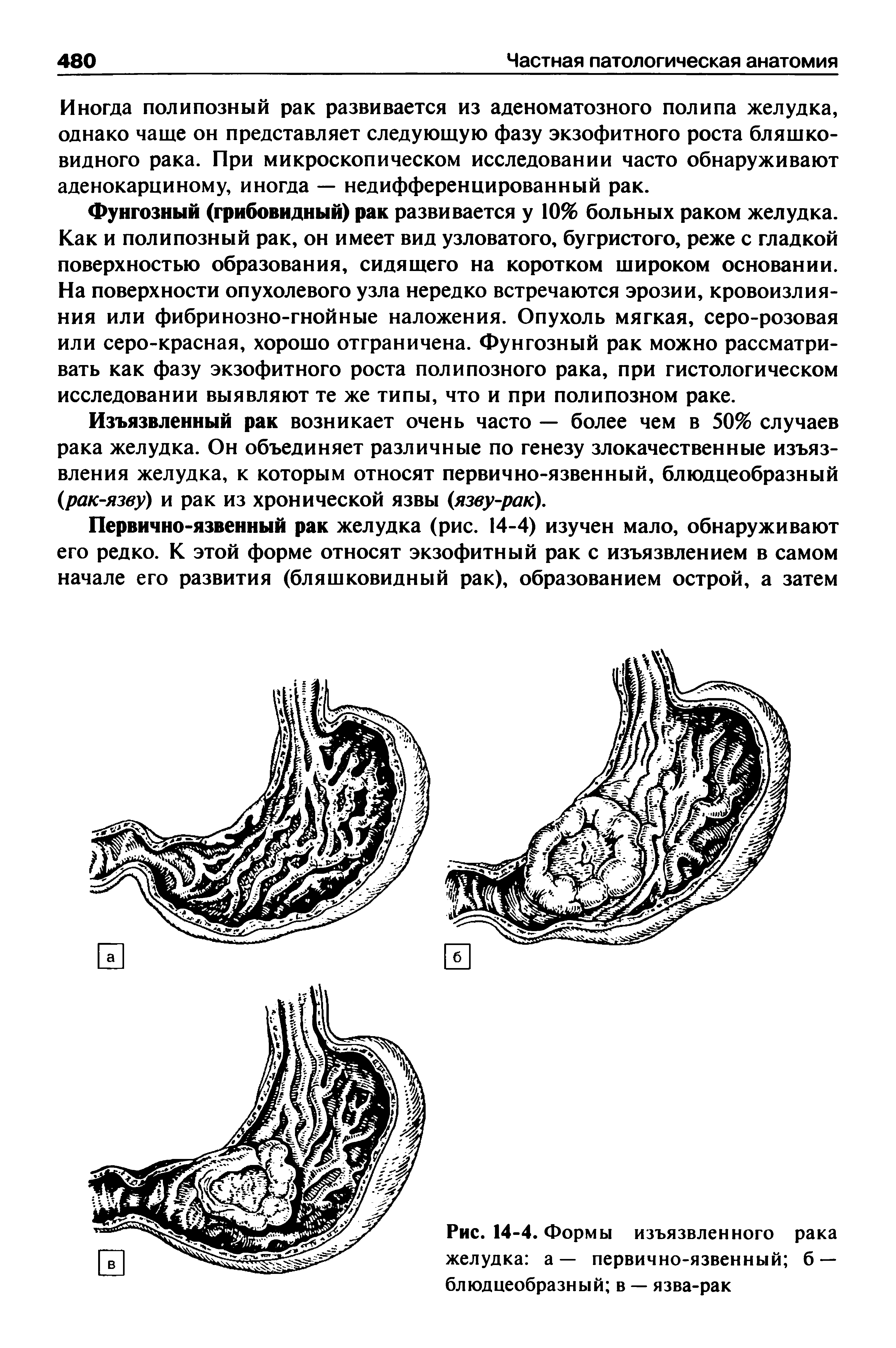 Рис. 14-4. Формы изъязвленного рака желудка а— первично-язвенный б — блюдцеобразный в — язва-рак...