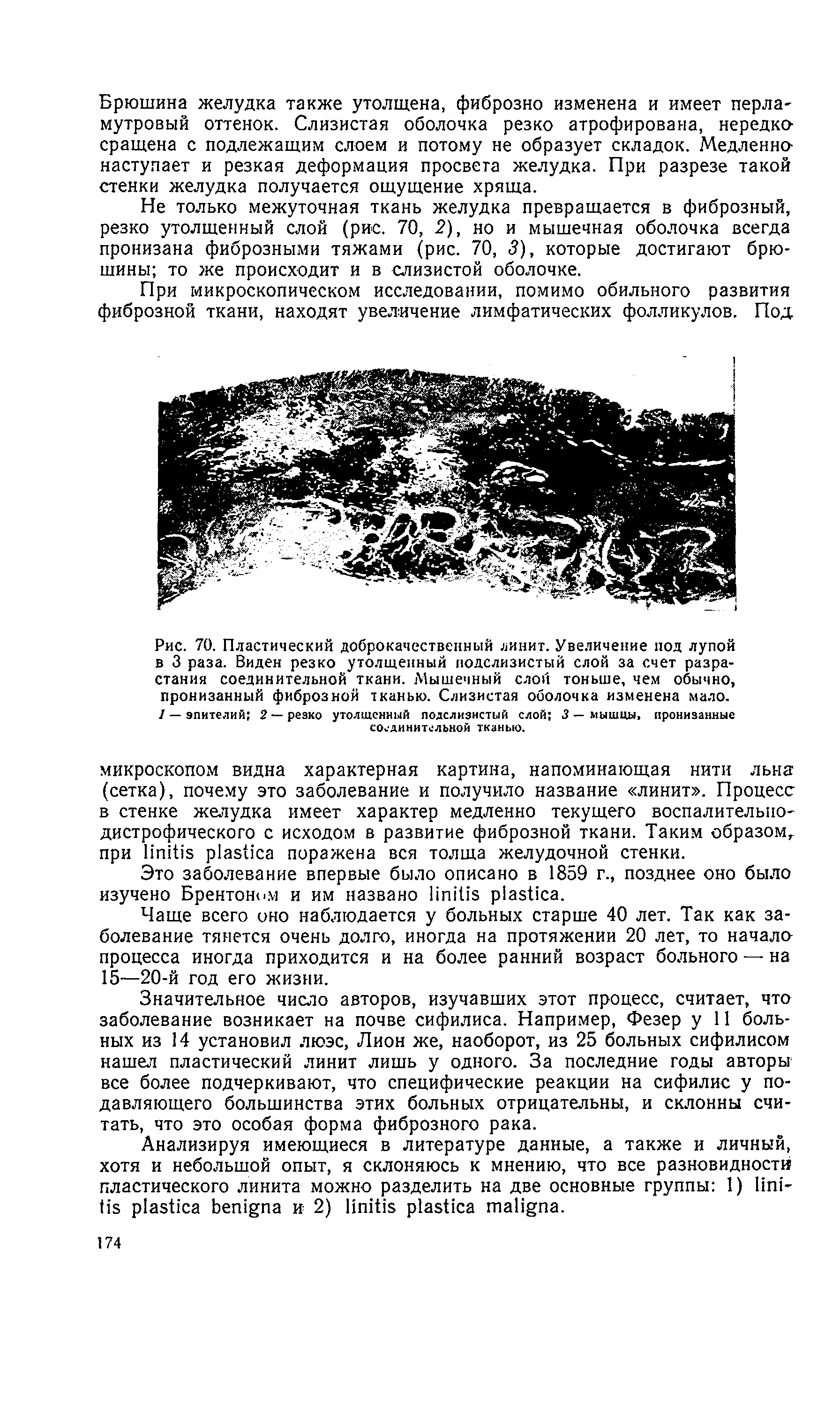 Рис. 70. Пластический доброкачественный линит. Увеличение под лупой в 3 раза. Виден резко утолщенный подслизистый слой за счет разрастания соединительной ткани. Мышечный слон тоньше, чем обычно, пронизанный фиброзной тканью. Слизистая оболочка изменена мало. / — эпителий 2 — резко утолщенный подслизистый слой 3 — мышцы пронизанные соединительной тканью.