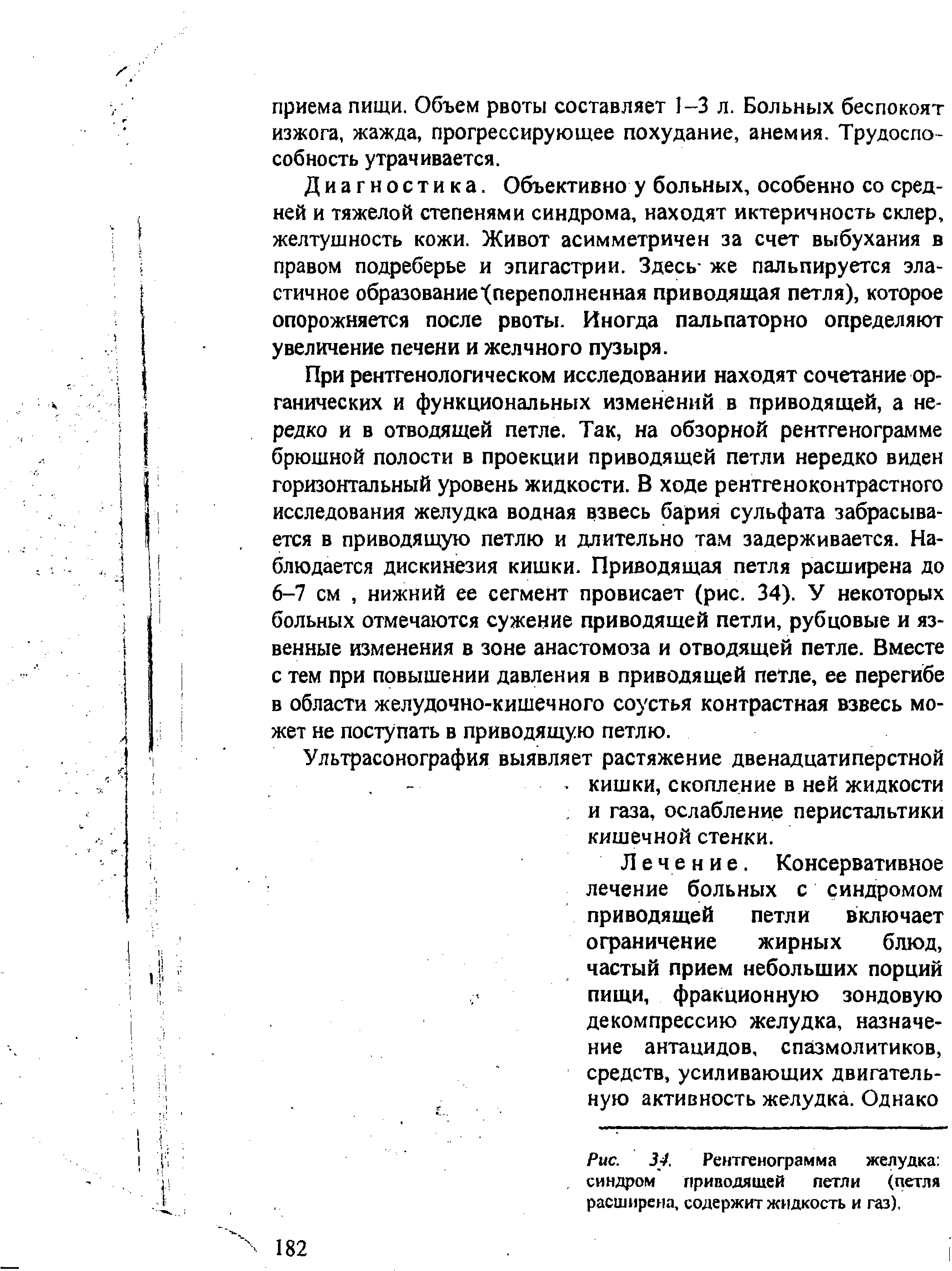 Рис. 34. Рентгенограмма желудка . синдром приводящей петли (петля расширена, содержит жидкость и газ).