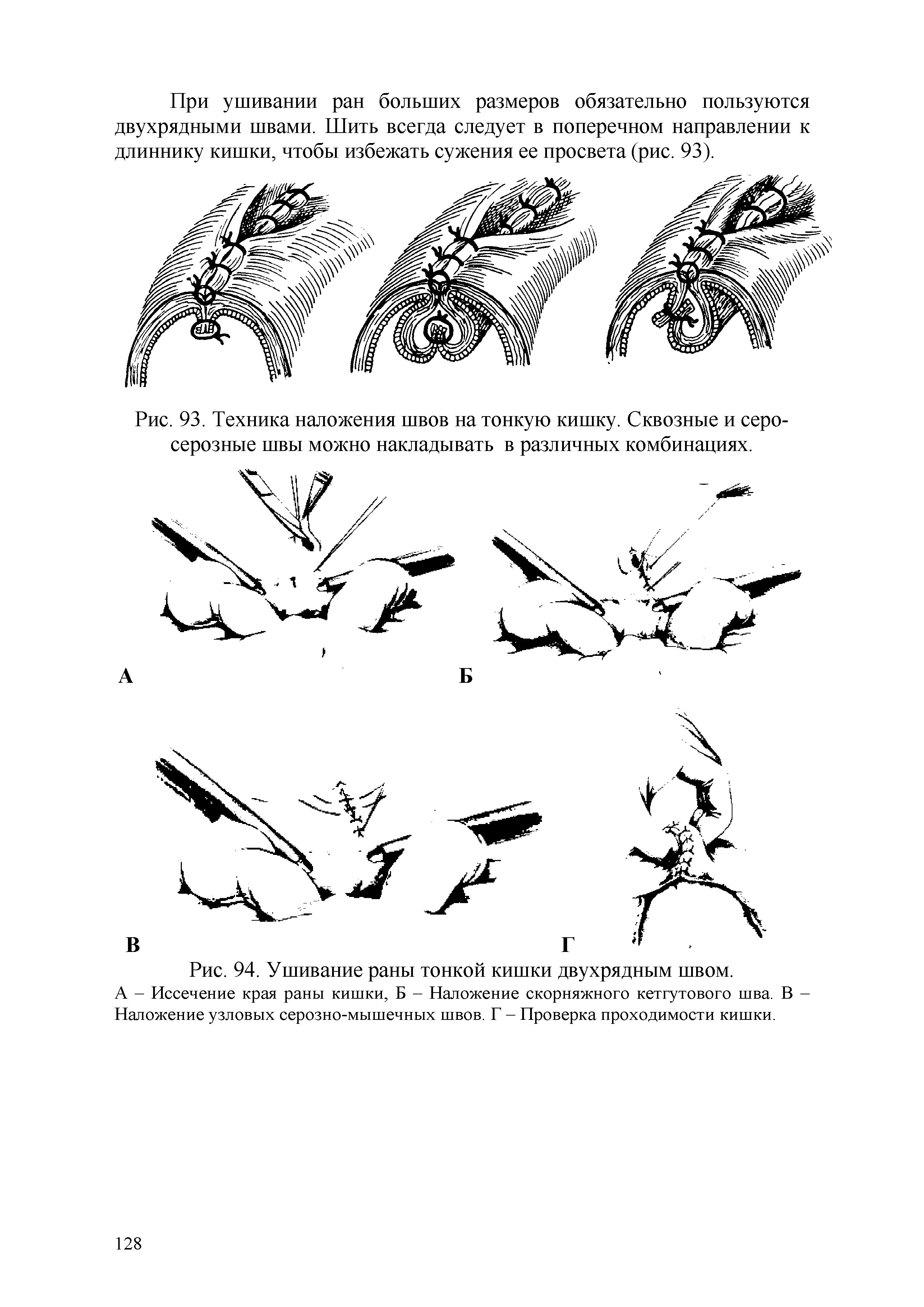 Рис. 94. Ушивание раны тонкой кишки двухрядным швом.