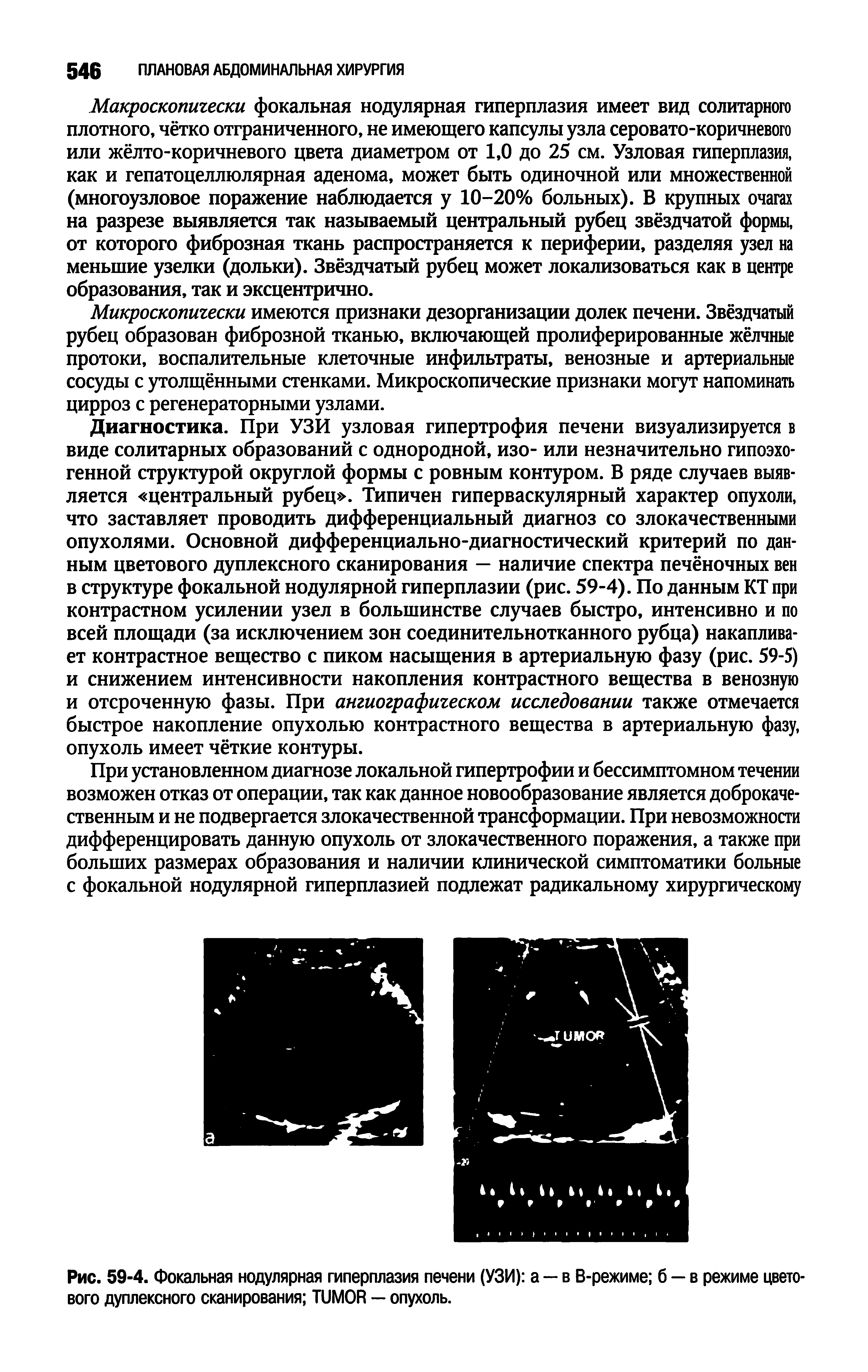 Рис. 59-4. Фокальная нодулярная гиперплазия печени (УЗИ) а — в В-режиме б — в режиме цветового дуплексного сканирования TUMOR — опухоль.