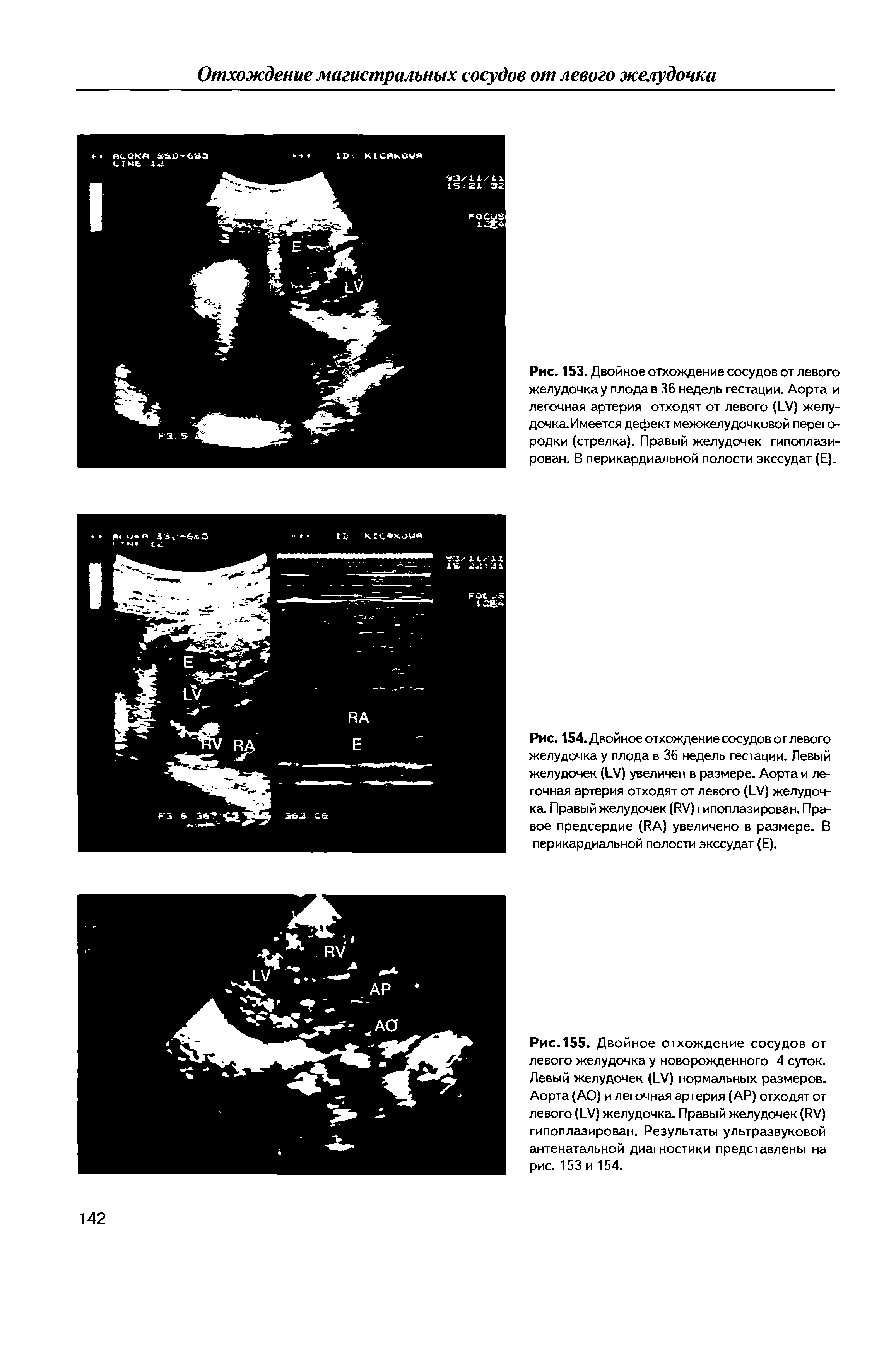 Рис. 153. Двойное отхождение сосудов от левого желудочка у плода в 36 недель гестации. Аорта и легочная артерия отходят от левого (1 /) желу-дочка.Имеется дефект межжелудочковой перегородки (стрелка). Правый желудочек гипоплази-рован. В перикардиальной полости экссудат (Е).