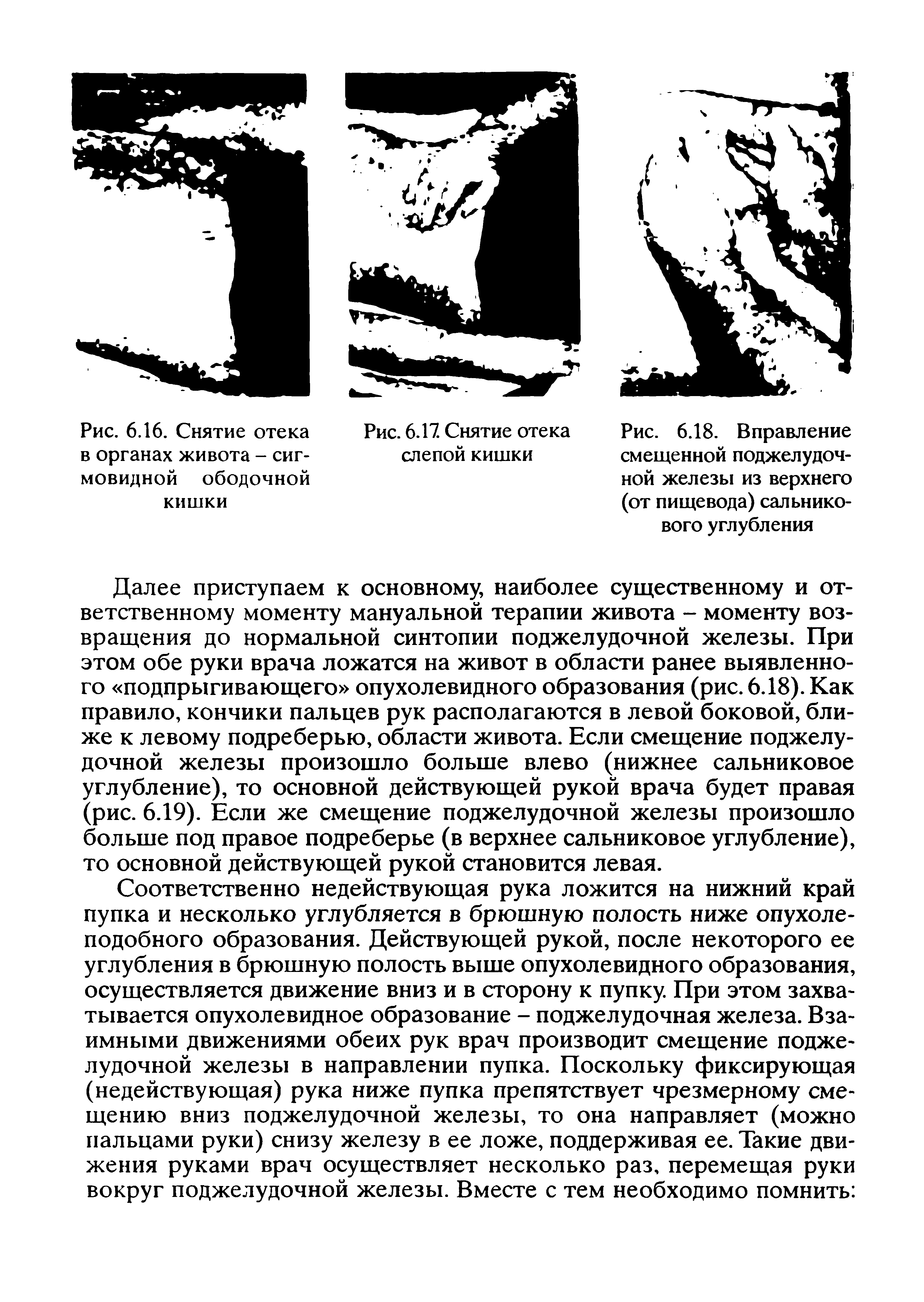 Рис. 6.18. Вправление смещенной поджелудочной железы из верхнего (от пищевода) сальникового углубления...