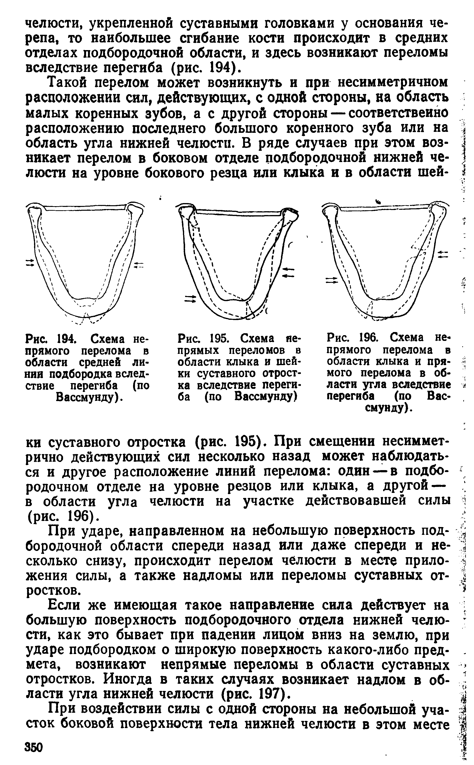 Рис. 195. Схема непрямых переломов в области клыка и шейки суставного отростка вследствие перегиба (по Вассмунду)...