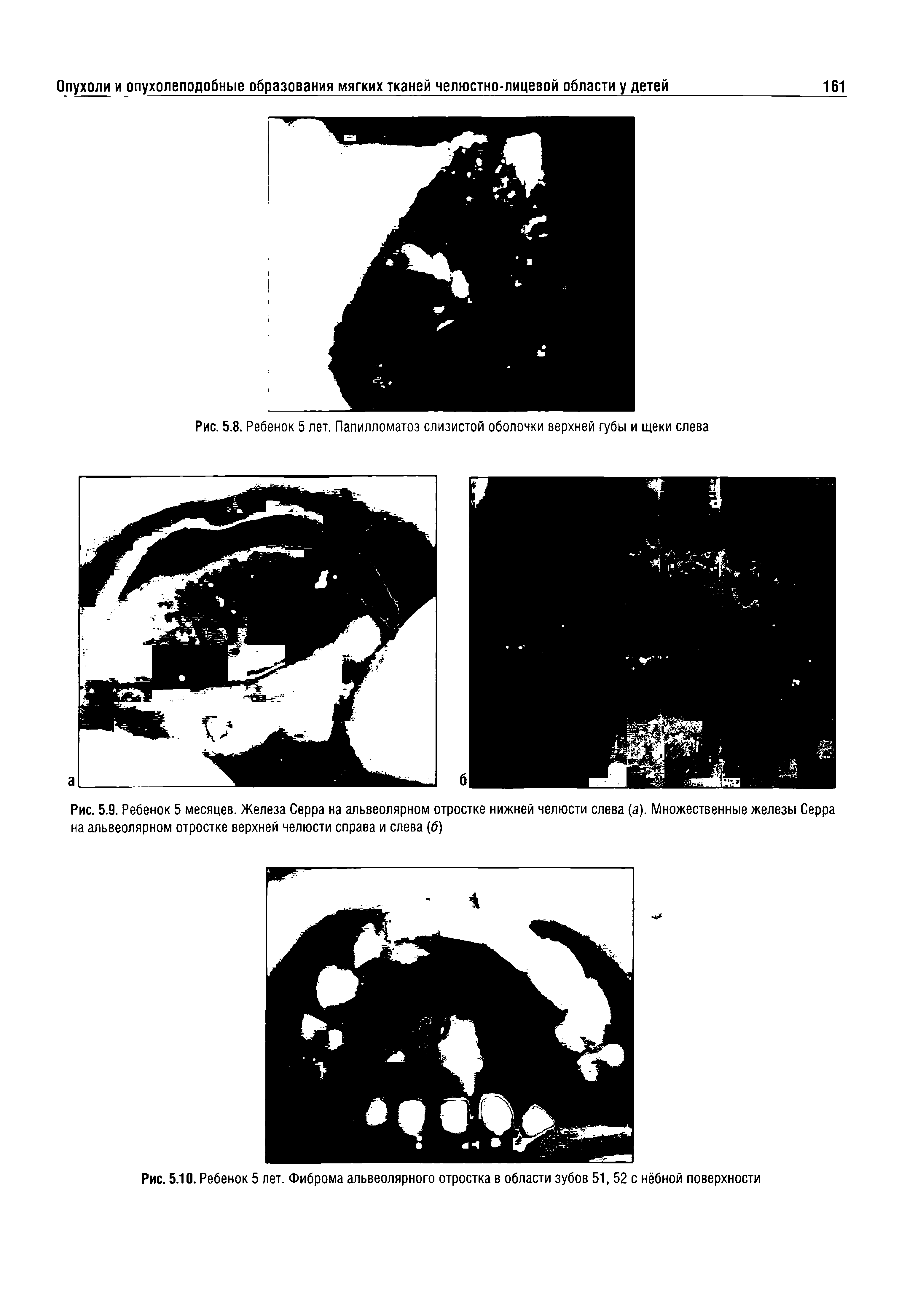 Рис. 5.9. Ребенок 5 месяцев. Железа Серра на альвеолярном отростке нижней челюсти слева (а). Множественные железы Серра на альвеолярном отростке верхней челюсти справа и слева (б)...