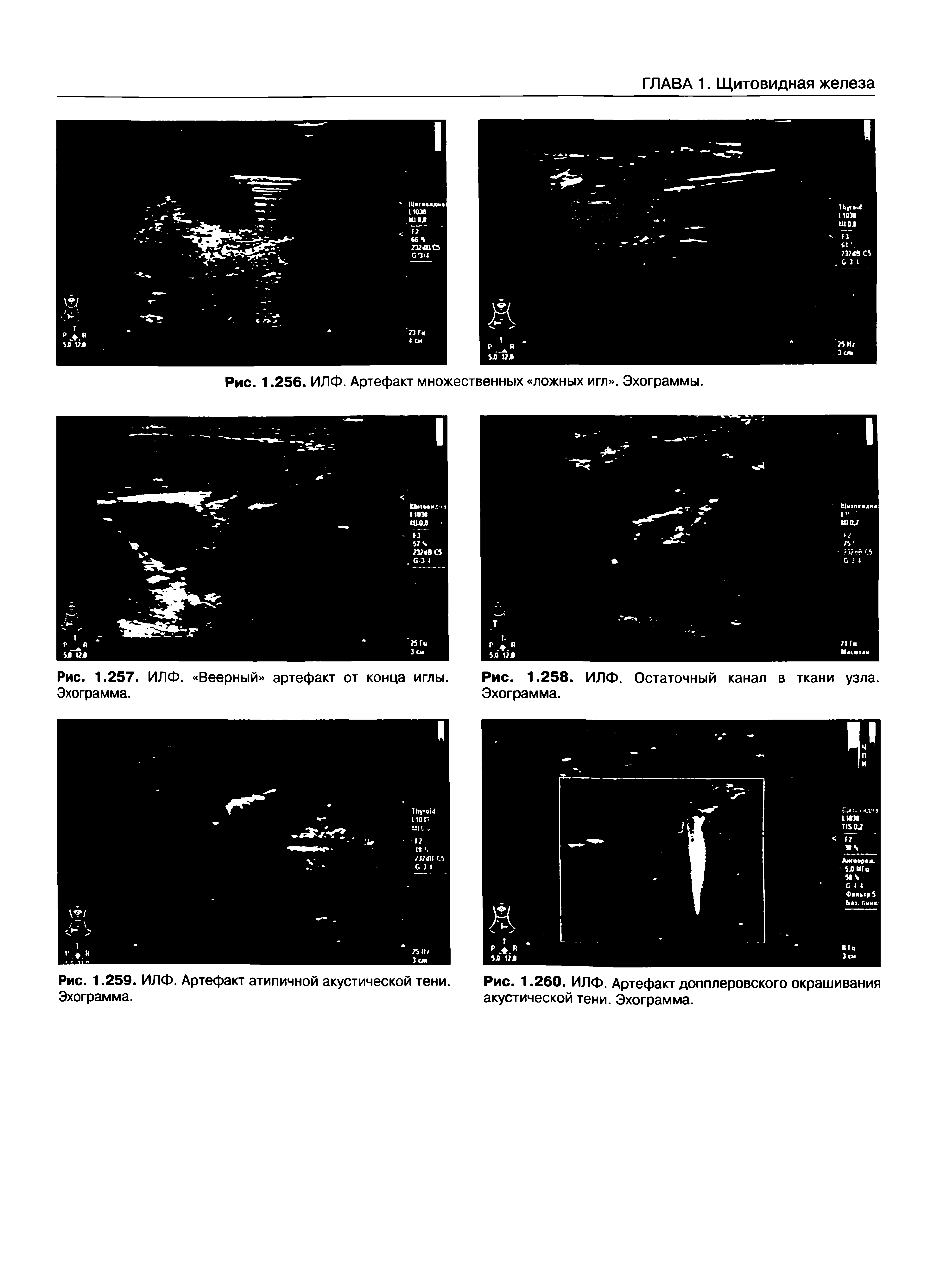 Рис. 1.260. ИЛФ. Артефакт допплеровского окрашивания акустической тени. Эхограмма.