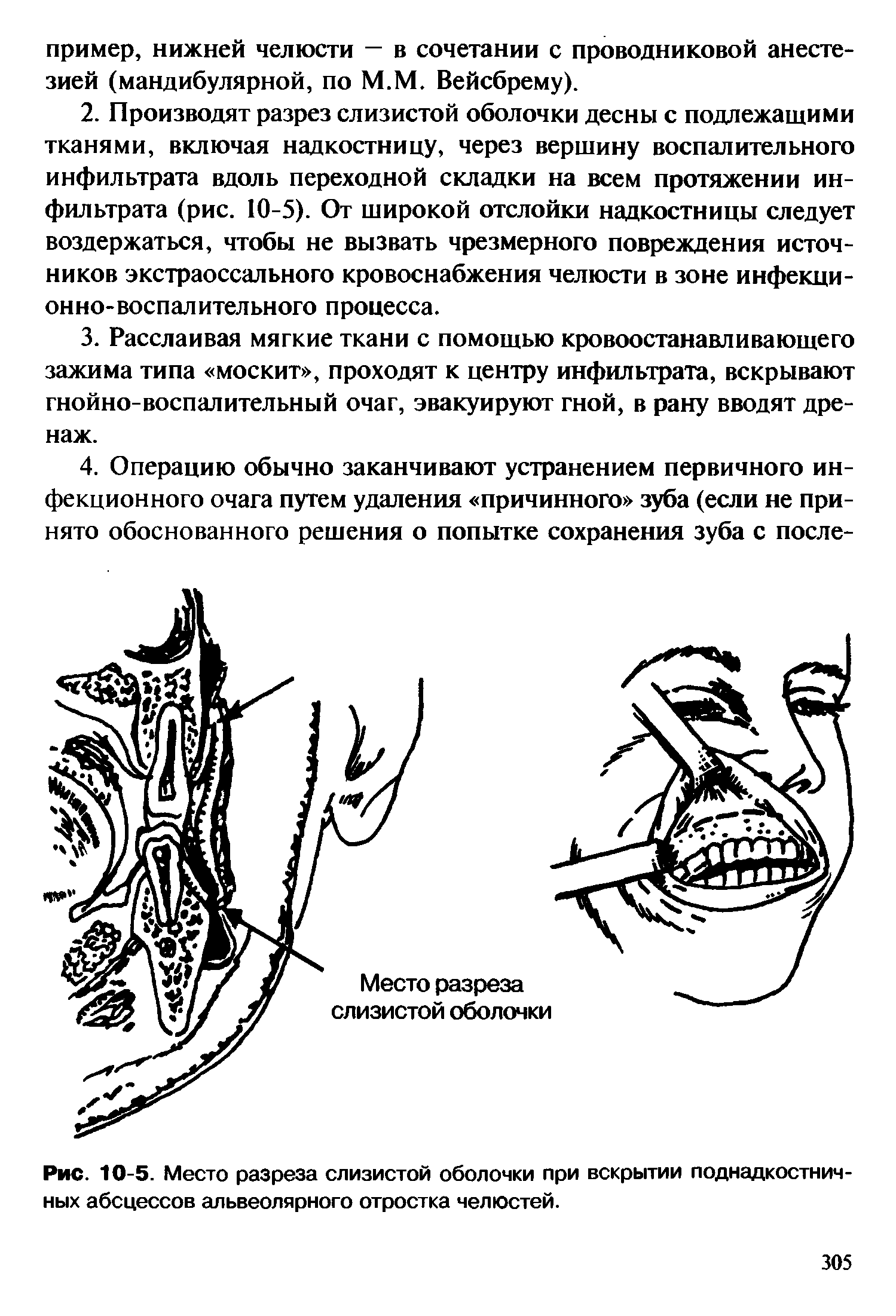 Рис. 10-5. Место разреза слизистой оболочки при вскрытии поднадкостничных абсцессов альвеолярного отростка челюстей.