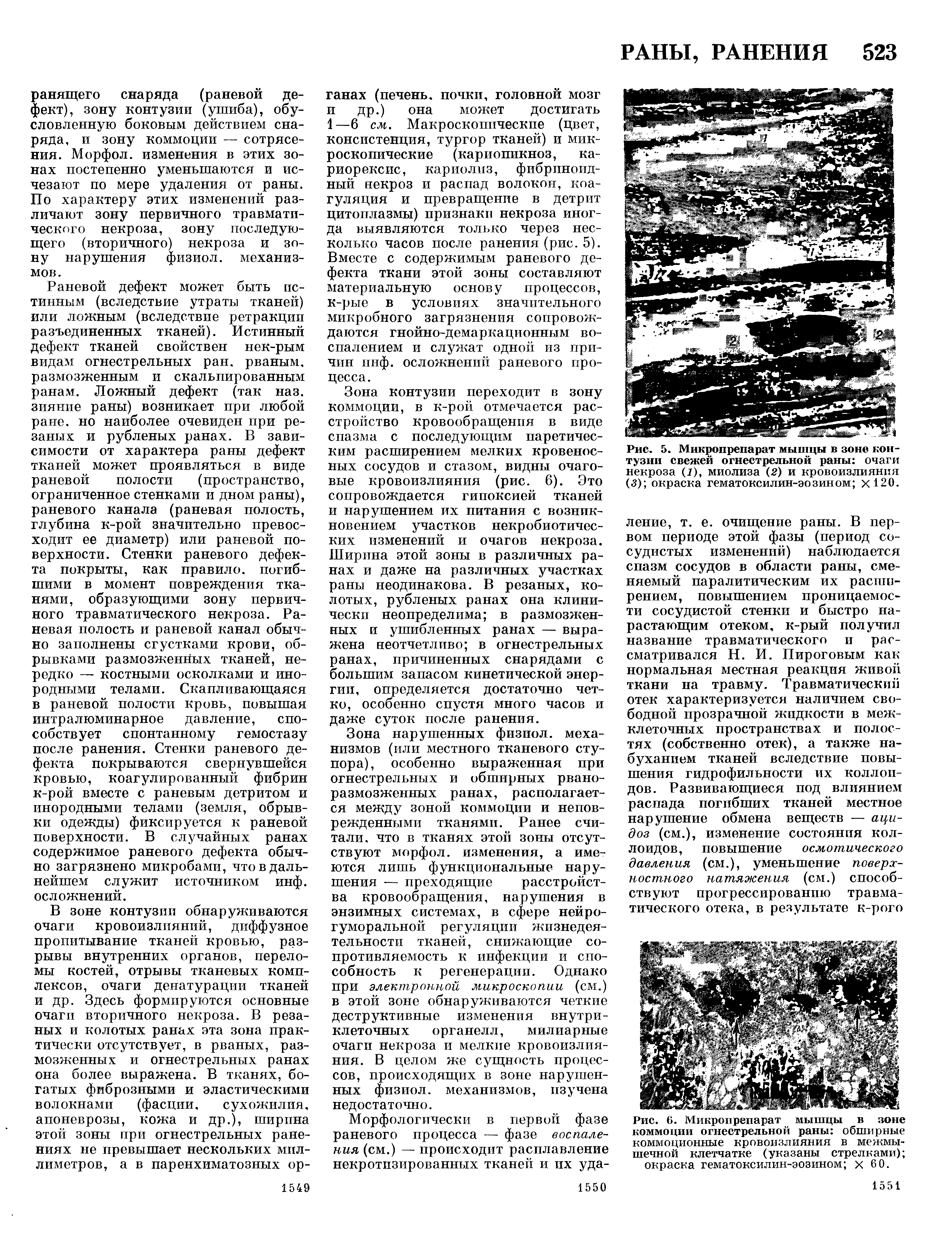 Рис. 6. Микропрепарат мышцы в зоне коммоции огнестрельной раны обширные коммоционные кровоизлияния в межмышечной клетчатке (указаны стрелками) окраска гематоксилин-эозином х 6 0.