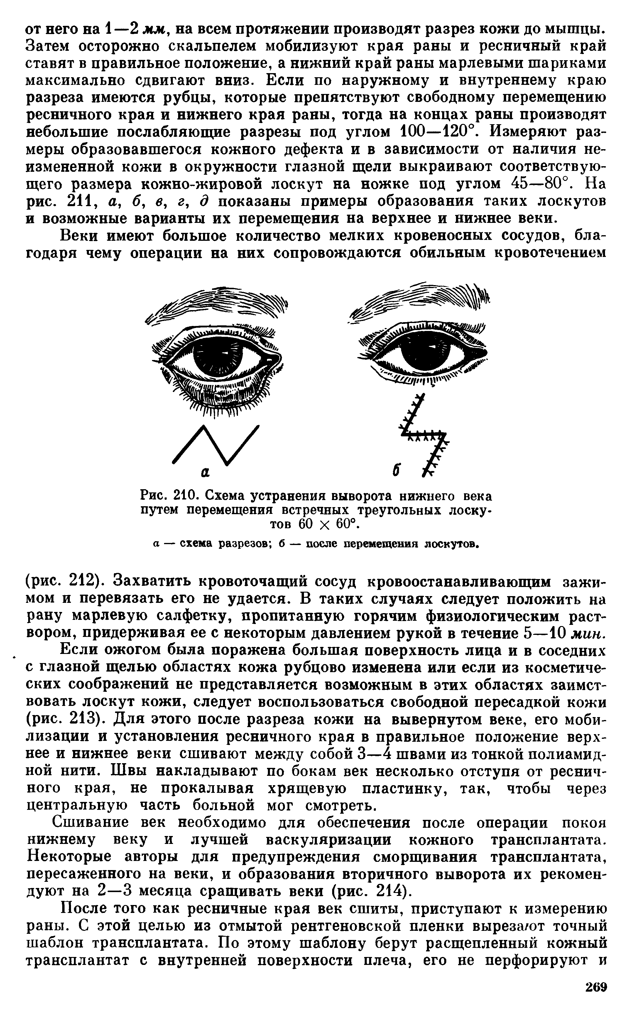 Рис. 210. Схема устранения выворота нижнего века путем перемещения встречных треугольных лоскутов 60 х 60°.