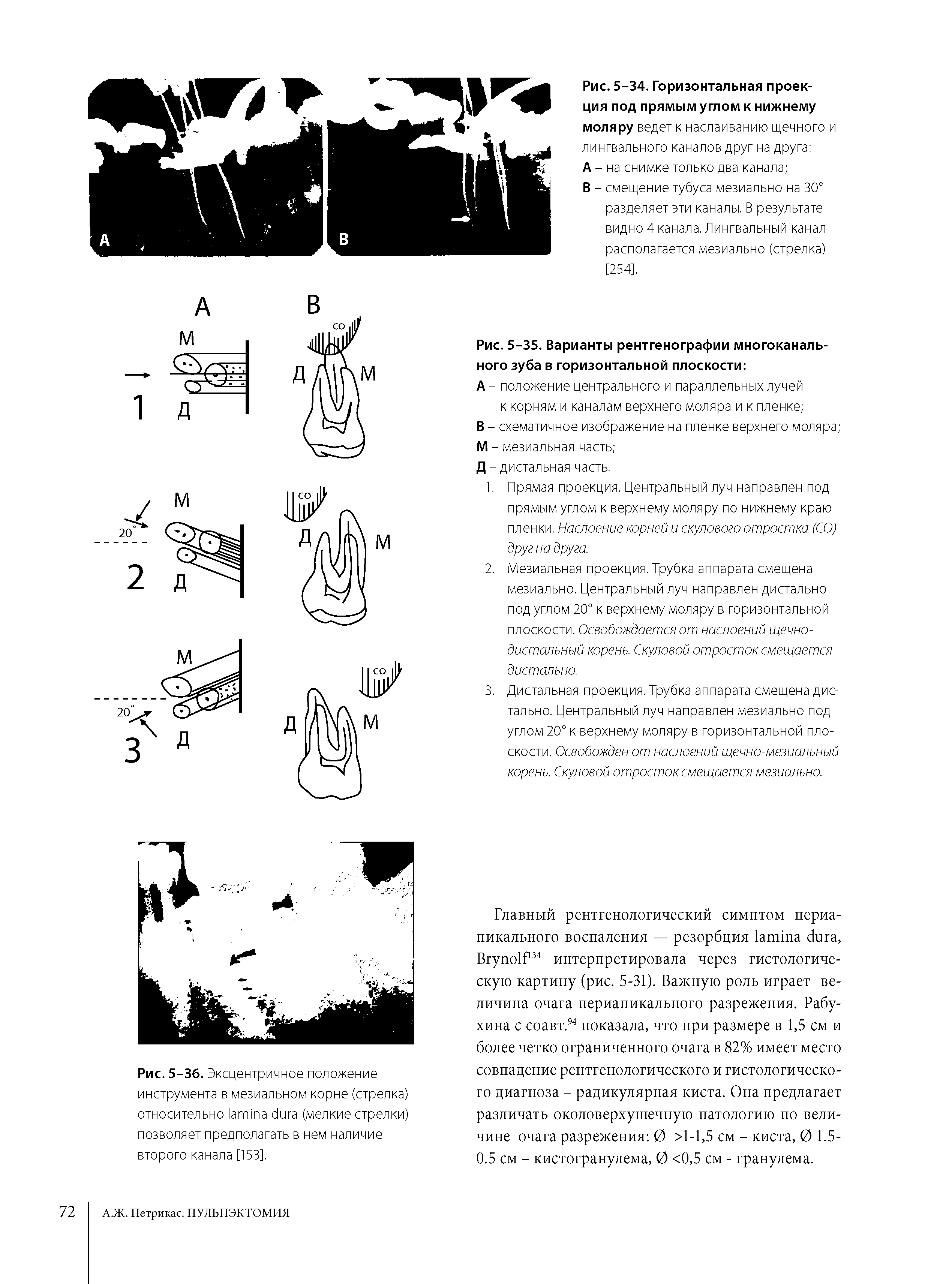 Рис. 5-36. Эксцентричное положение инструмента в мезиальном корне (стрелка) относительно (мелкие стрелки) позволяет предполагать в нем наличие второго канала [153].