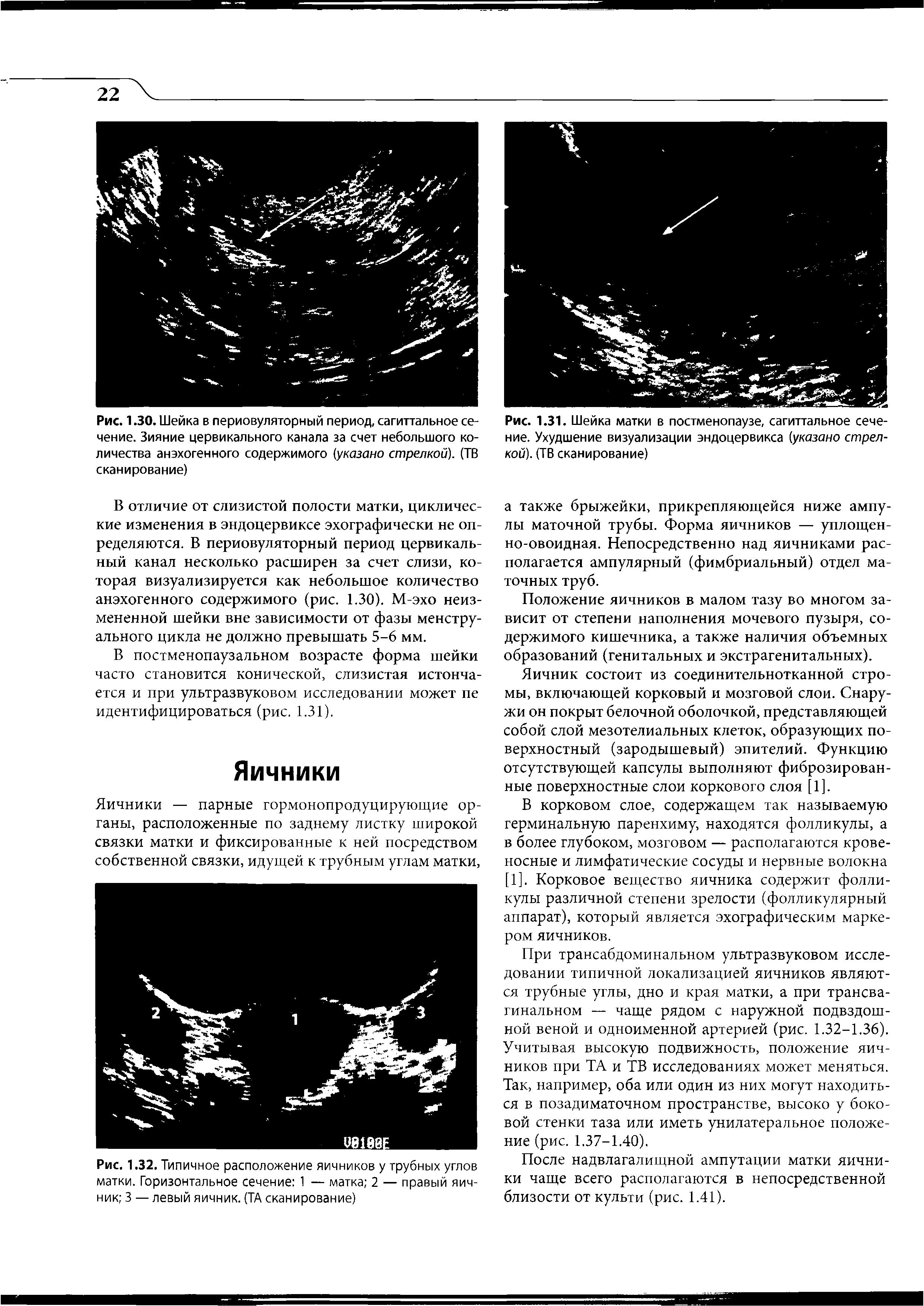 Рис. 1.31. Шейка матки в постменопаузе, сагиттальное сечение. Ухудшение визуализации эндоцервикса (указано стрелкой). (ТВ сканирование)...